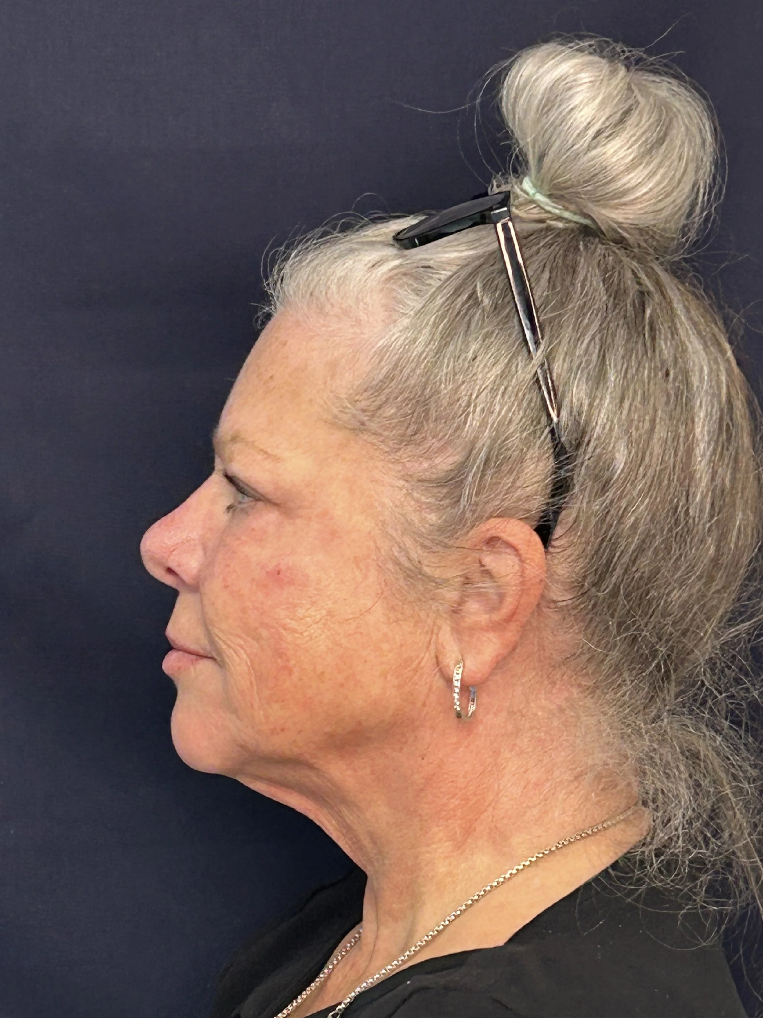 After Daxxify and RHA 4, RHA 3 and Redensity to the Temples, Cheeks, and Chin