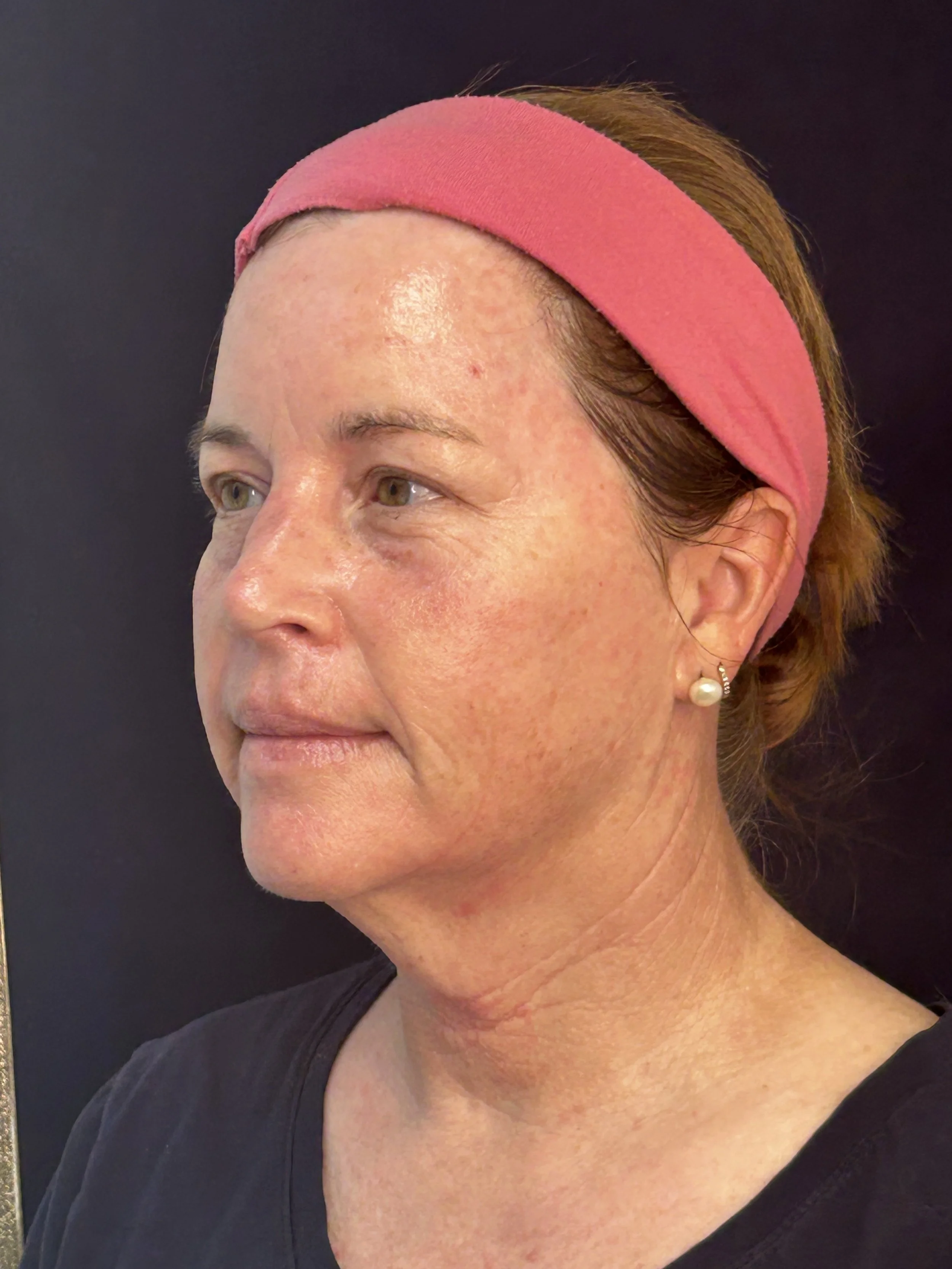 After First Opus Plasma Treatment head & neck