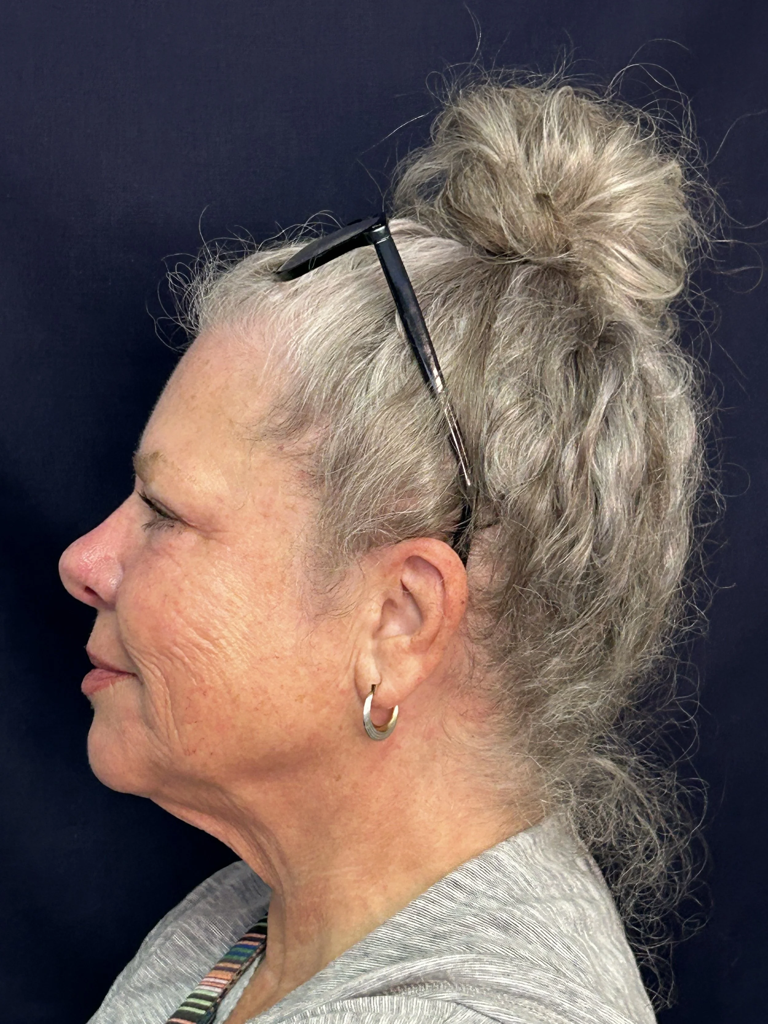 After 1st Opus Treatment