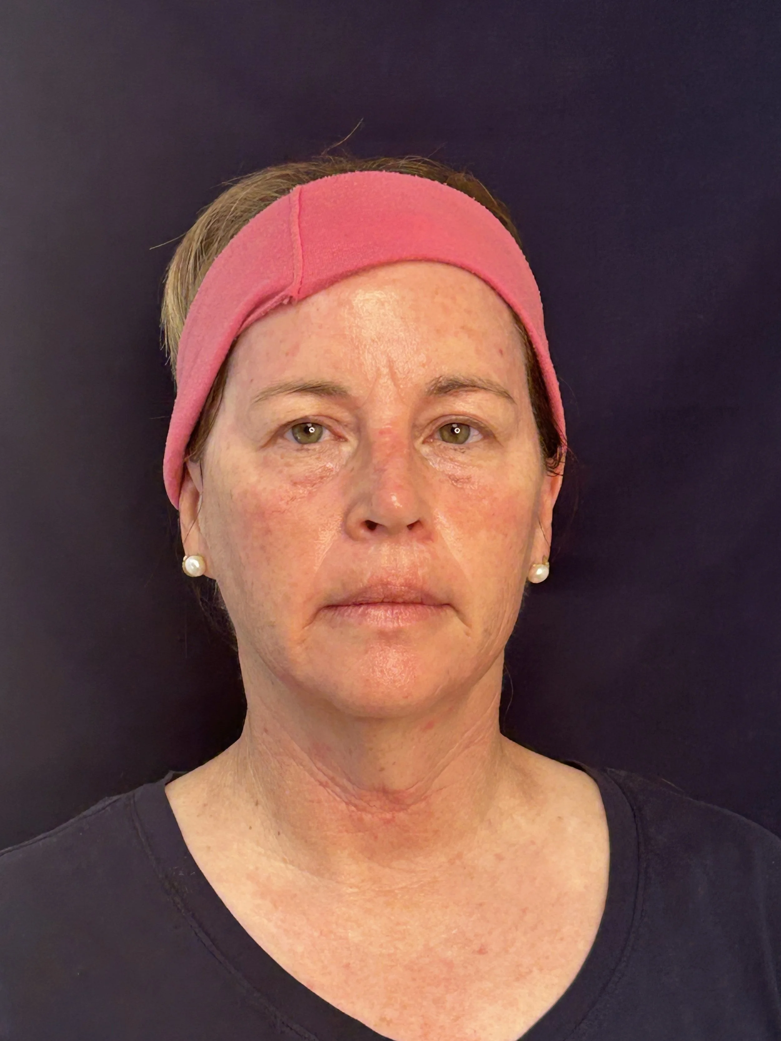 After First Opus Plasma Treatment head & neck