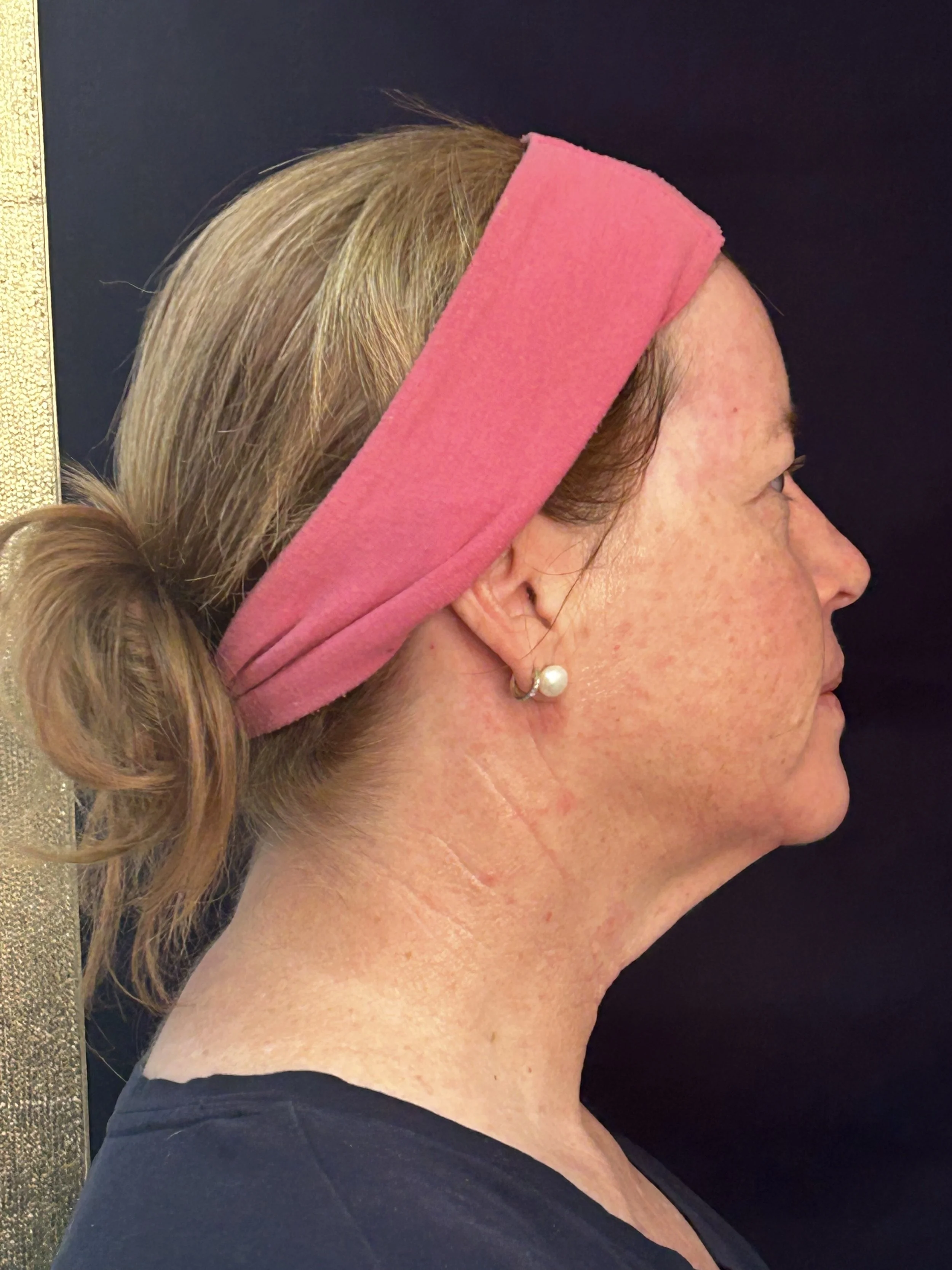 After First Opus Plasma Treatment head & neck