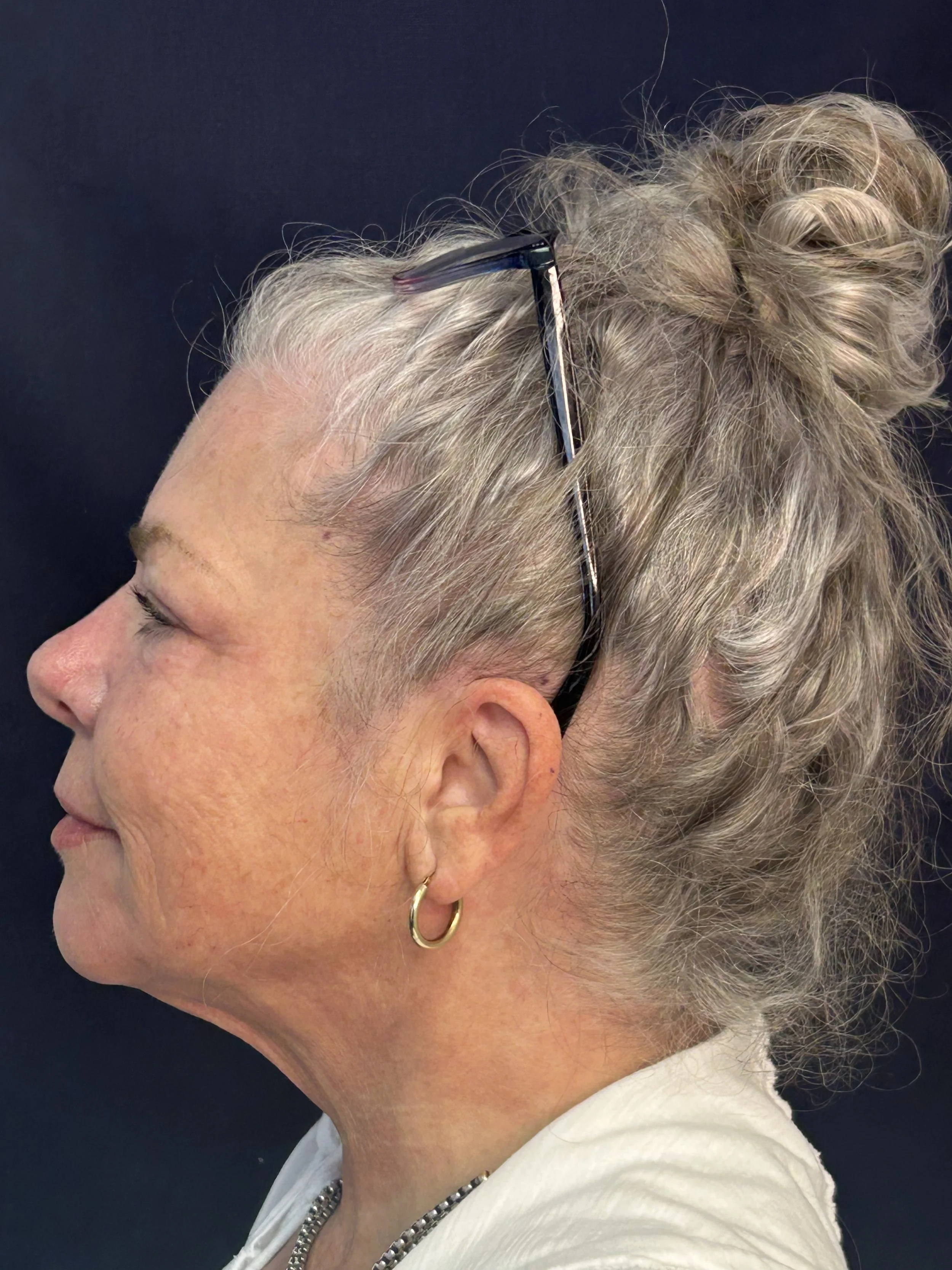 After 2nd Opus treatment face/neck