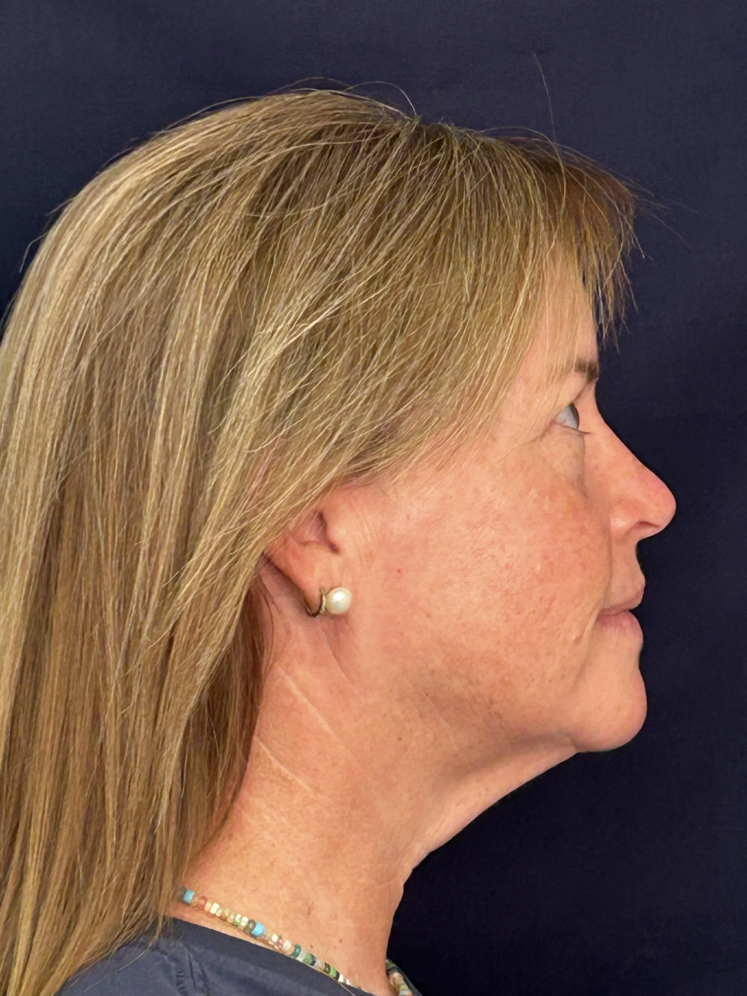 After 2nd Opus Plasma Treatment head & neck