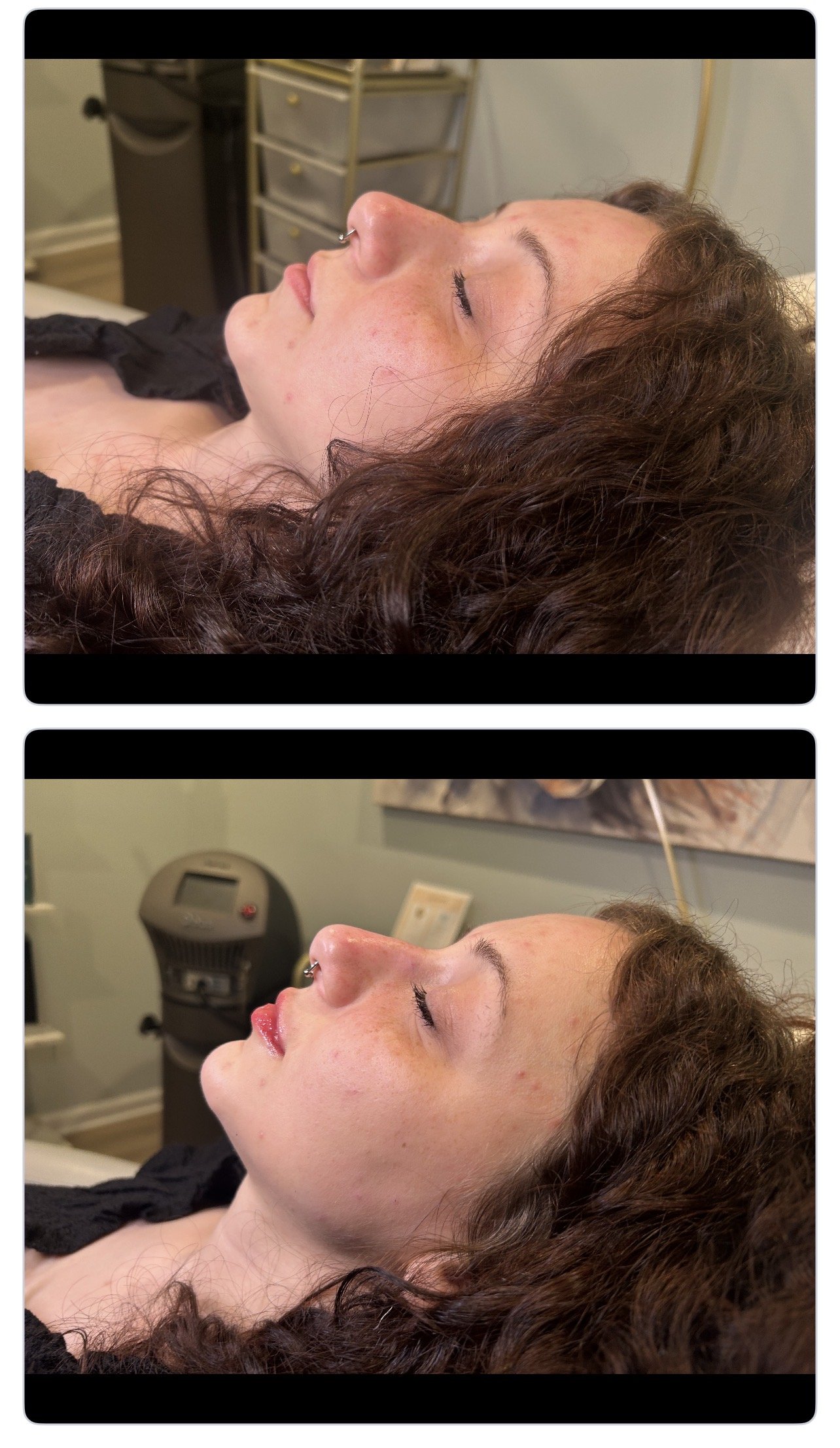 Lip and chin filler