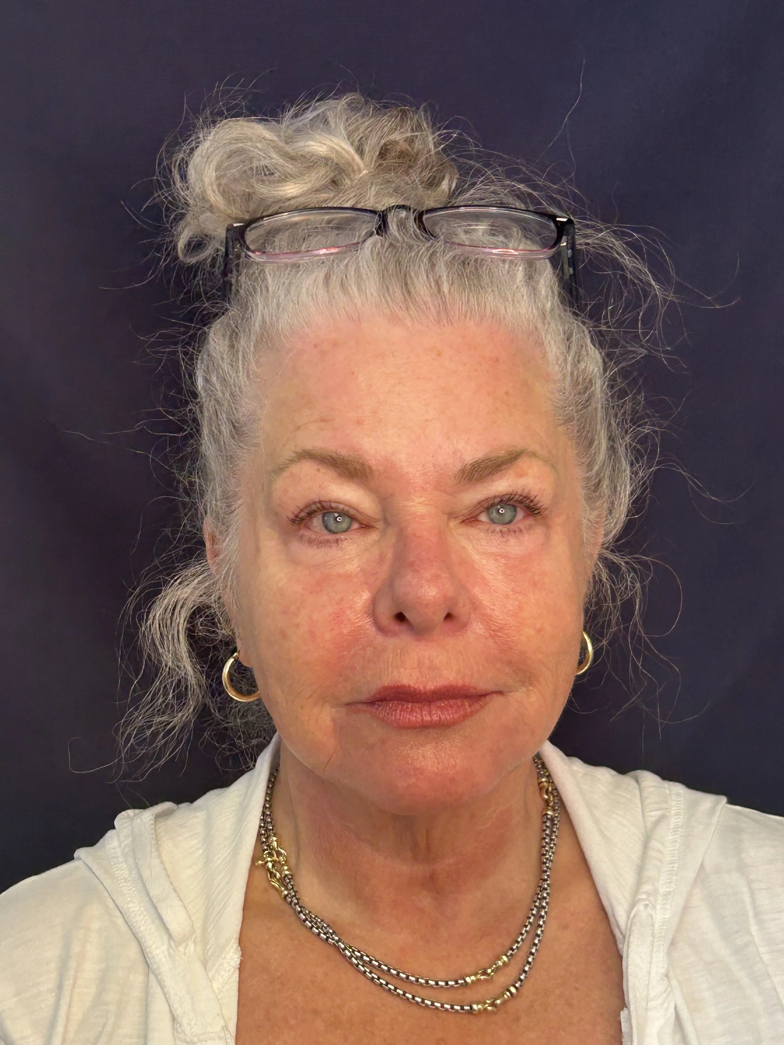 After 2nd Opus treatment face/neck