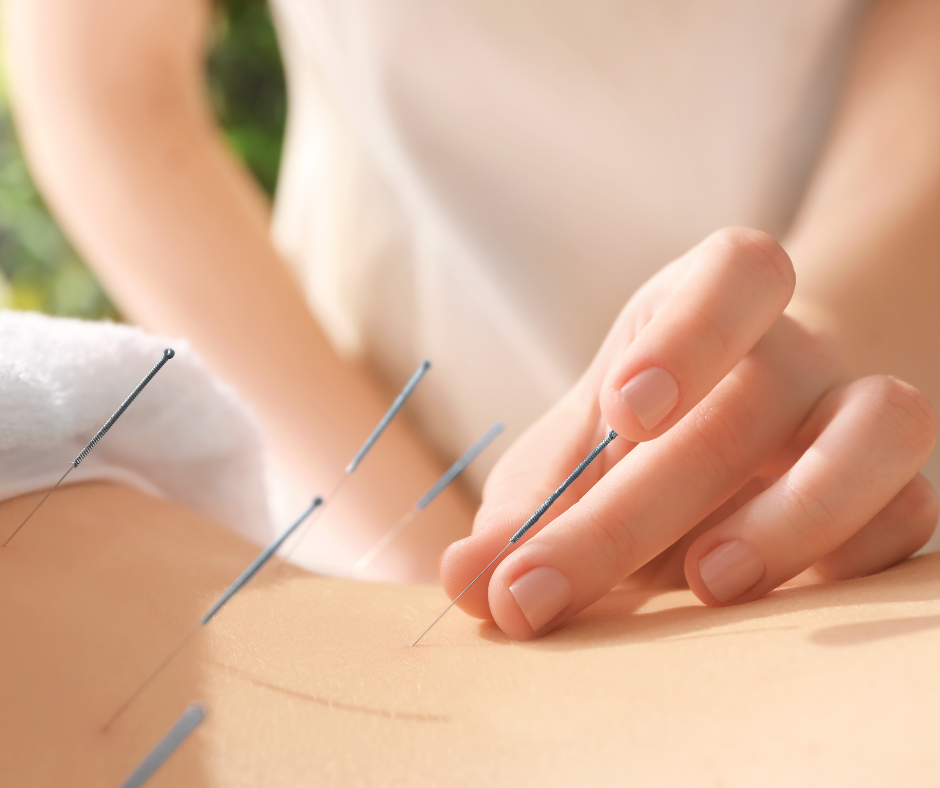 acupuncture2.png