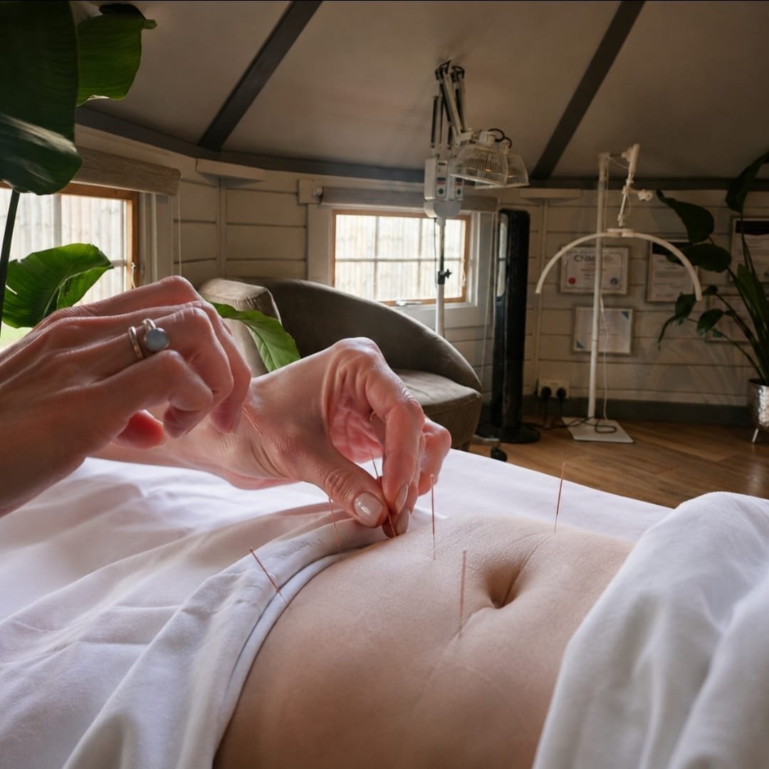 Acupuncture and IVF: Supporting Your Fertility Journey Naturally