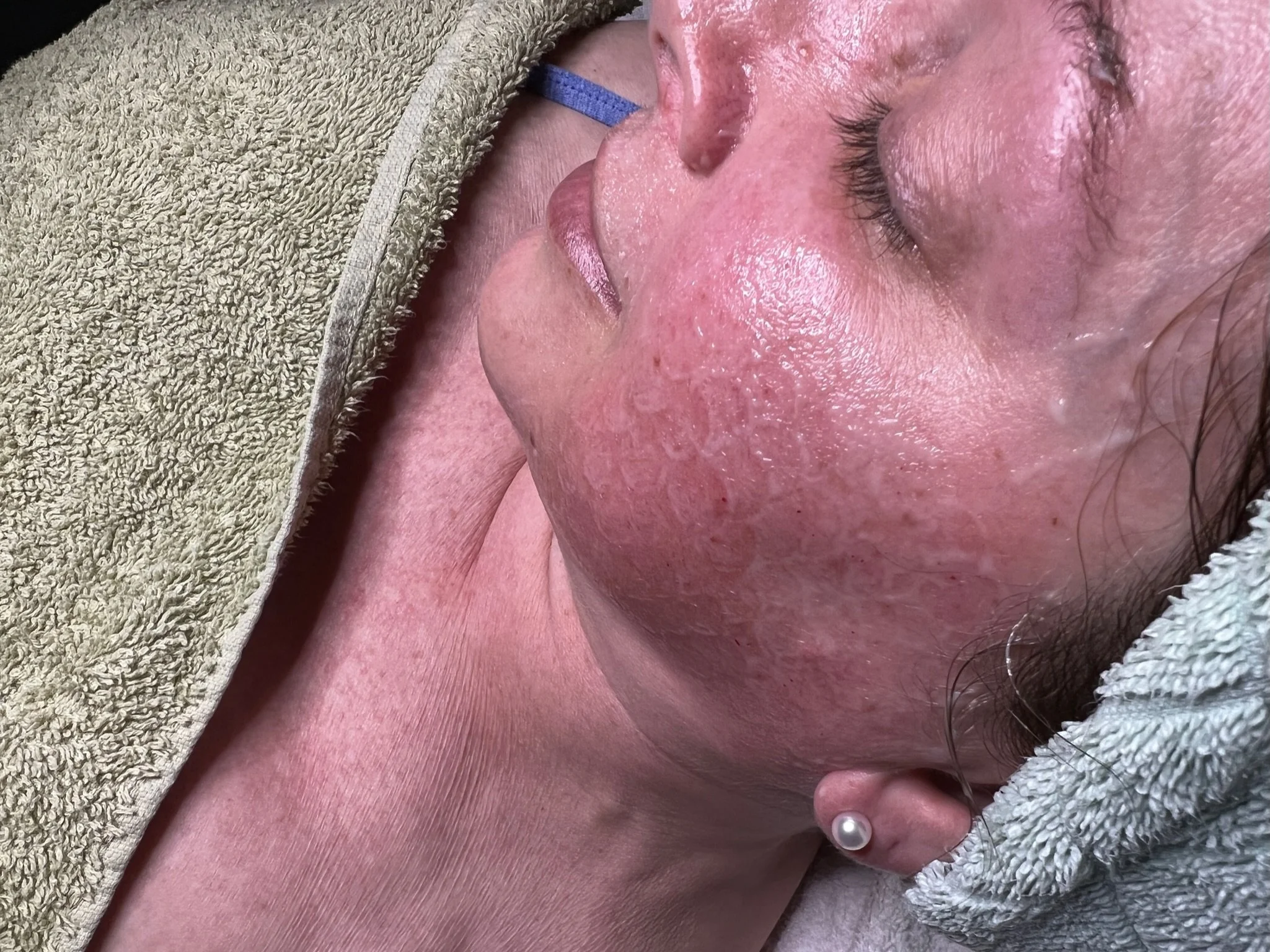 Microneedling facial treatment in progress to support smoother skin texture and a refreshed complexion