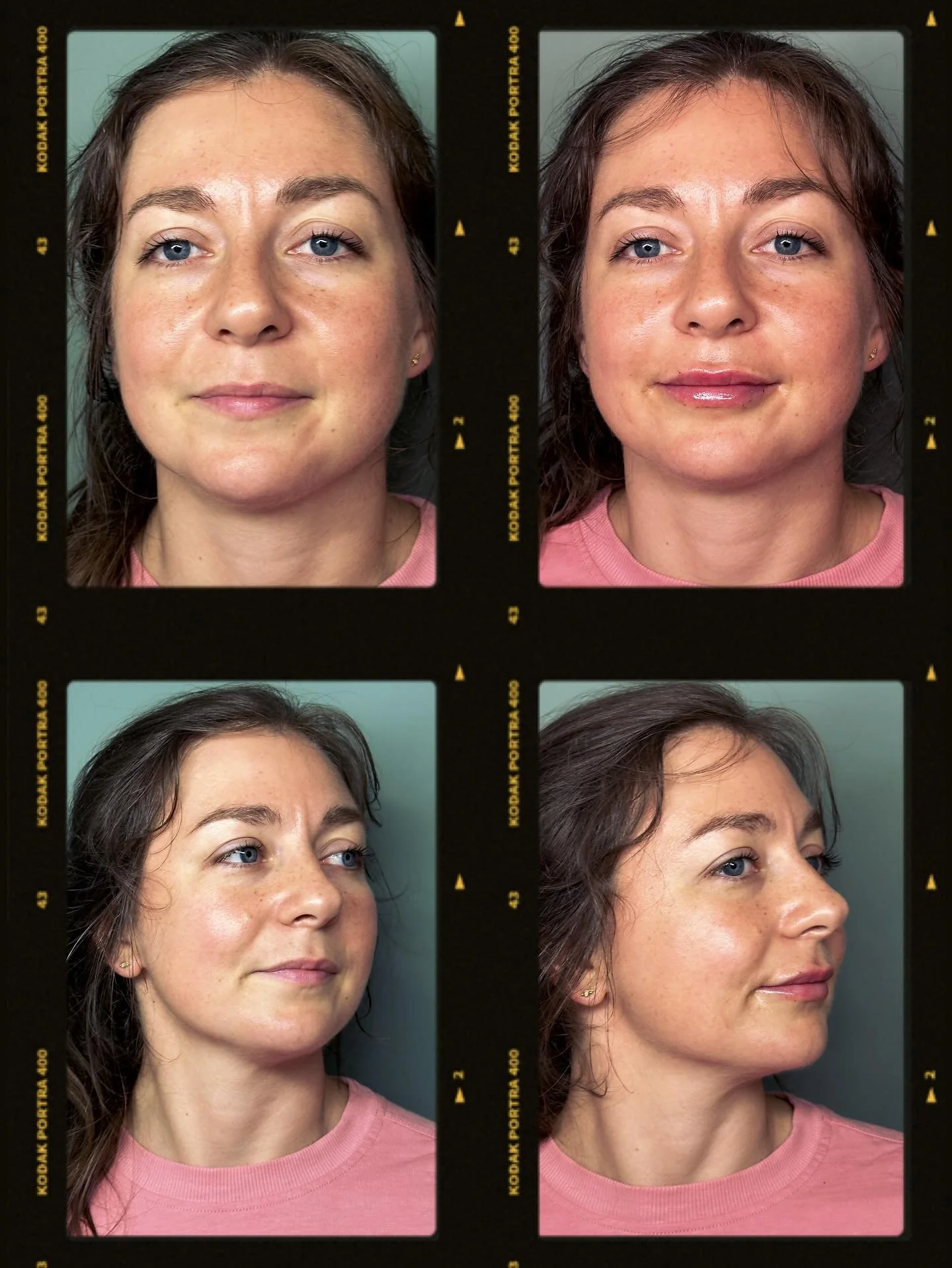 💋 1/2 syringe of Juvederm 💋

Would you love to enhance your natural lips ?! 

📣Call or text us today for a consultation 📣

🤍🤍🤍🤍🤍
Ann Casamento, MSN, APRN, FNP-C
Destiny Monroe, LE
Christina Enzmenn, OB-GYN
Easton Advanced Aesthetics
📞 443 2