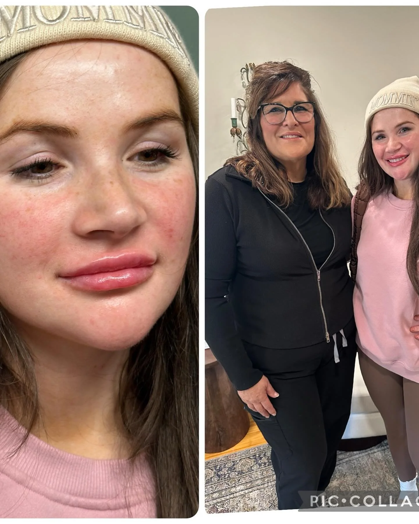 Look at these gorgeous lips! Taylor was our giveaway winner  for a free syringe of lip filler! She is not only beautiful on the outside but on the inside as well!  Just look at her! She is on fire!🔥 Treat yourself and buy the lips! 🥰💉👄