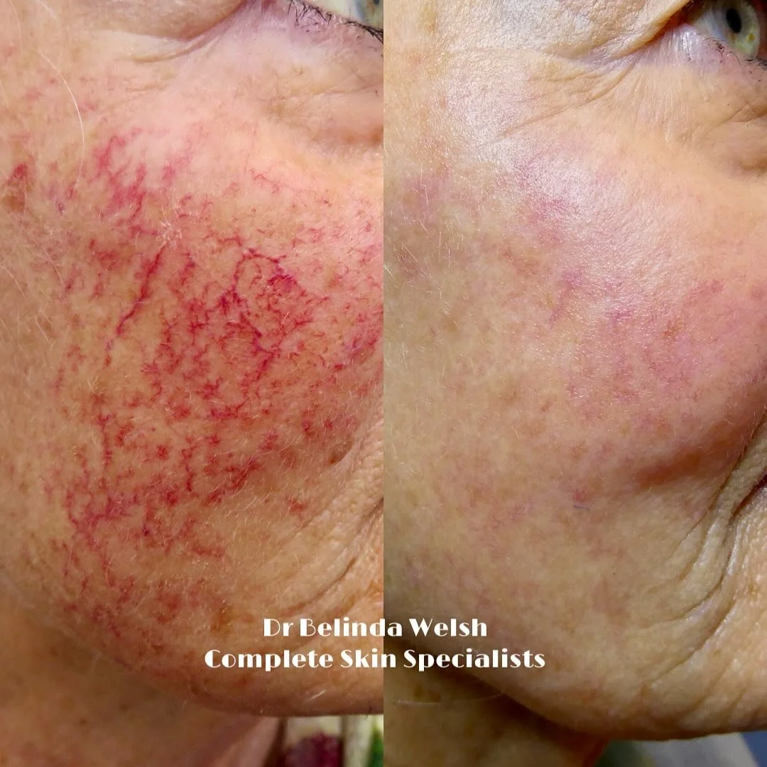 Results: Clearer skin and healthier glow!

This wonderful patient has been living with dermatomyositis, an autoimmune condition that required long-term immune-modifying medications. Both her condition and the treatments had taken a toll on her skin, 