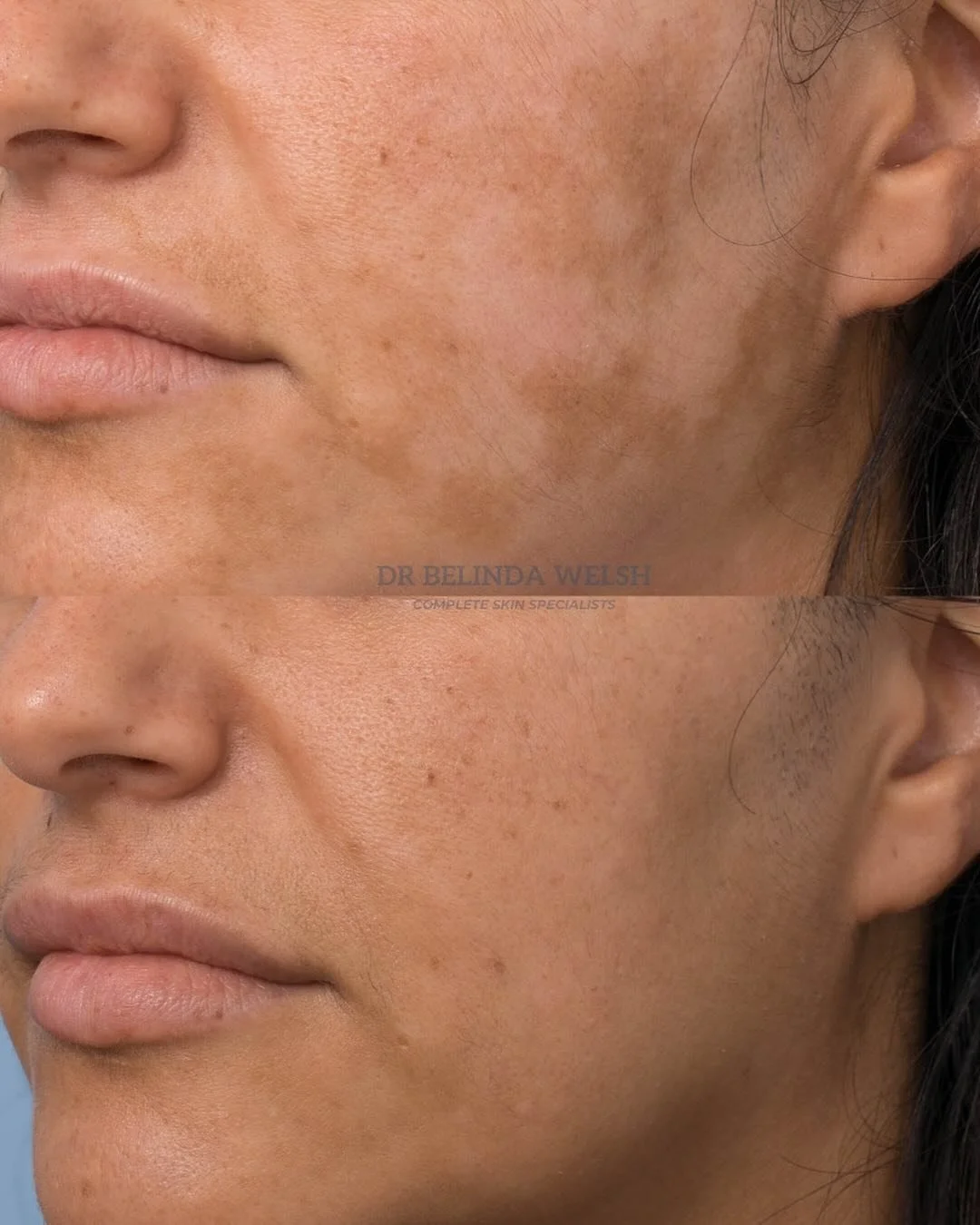 Treating Facial pigmentation- Diagnosis is key 🔑 ⁣
⁣
This beautiful lady was referred to me with a diagnosis of melasma &ndash; a common cause of facial pigmentation. At first glance it looked possible but something didn&rsquo;t quite fit&hellip;⁣
⁣