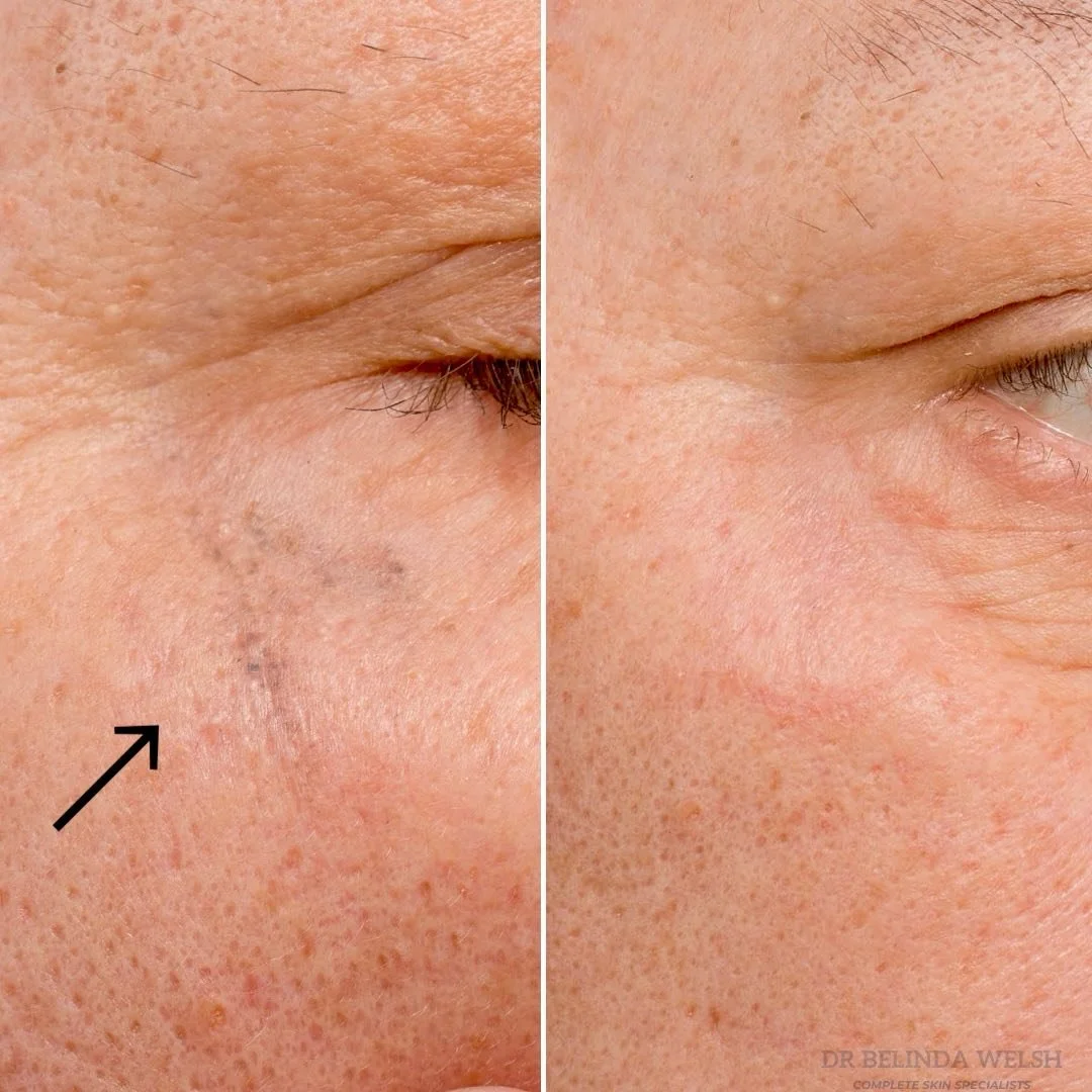 ⁣
Traumatic &ldquo;Tattoo&rdquo; Gone in One Session⁣
⁣
This lovely lady came to me after a fall left gravel embedded in her right upper cheek. After the wound healed, the skin was scarred and pigmented and she couldn&rsquo;t &ldquo;get it out&rdquo;