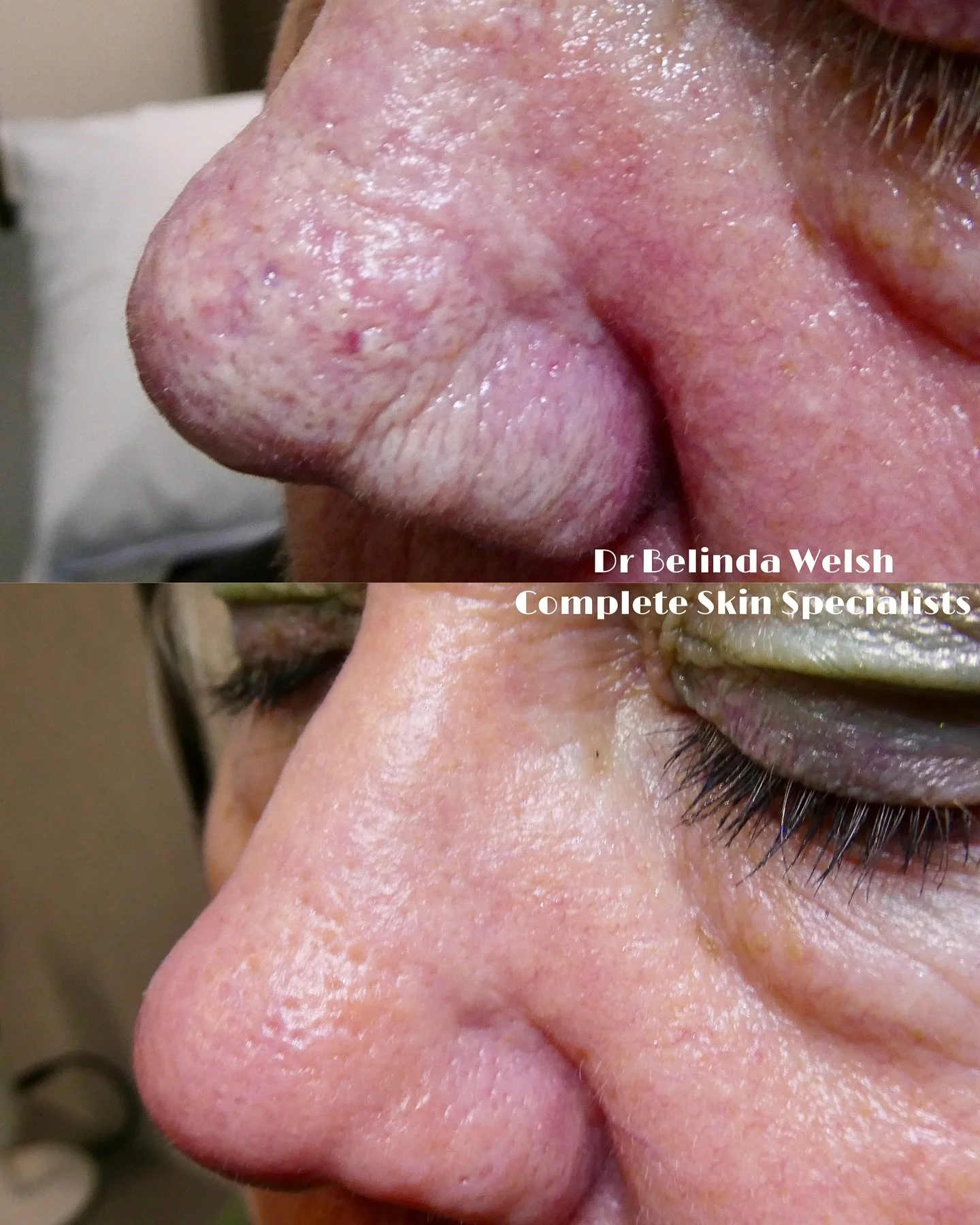 📸 CO2 Laser Rejuvenation for Sun-Damaged, Rosacea-Prone Skin⁣
⁣
This lovely lady came to see me with long-standing changes from sun damage and rosacea &mdash; including yellow skin discolouration, bumpy texture, and thickening of the nose due to ear