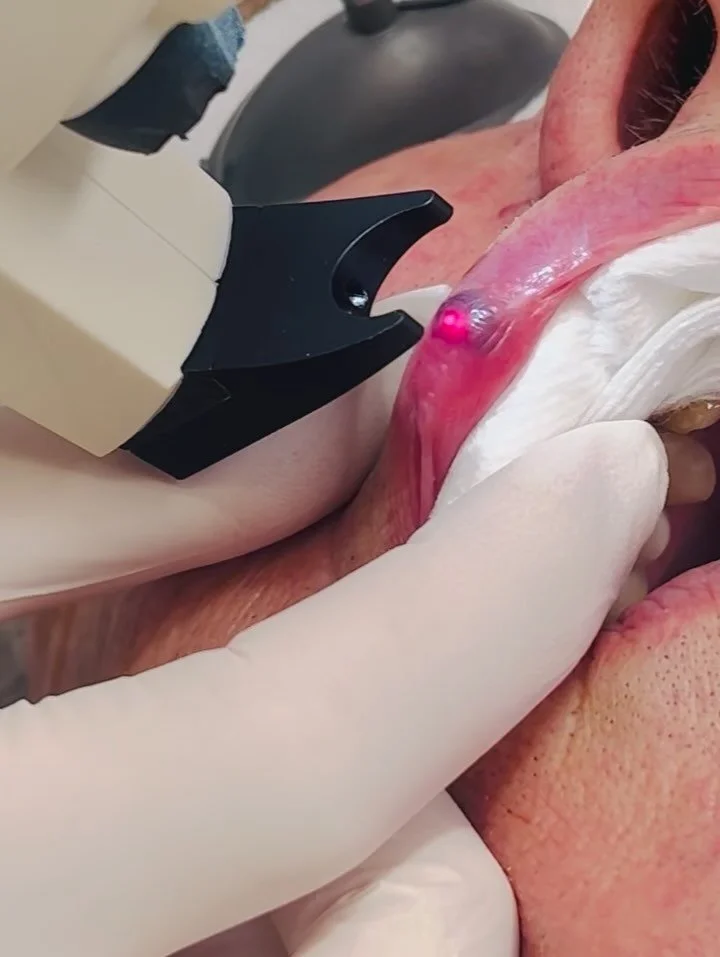 ⁣👄 Laser treatment of a Venous Lake on the lip⁣
⁣
This is a common condition called a venous lake &ndash; a soft, dark blue bump caused by a collection of dilated blood vessels, often seen on the upper or lower lips or face. ⁣
⁣
These are quite harm