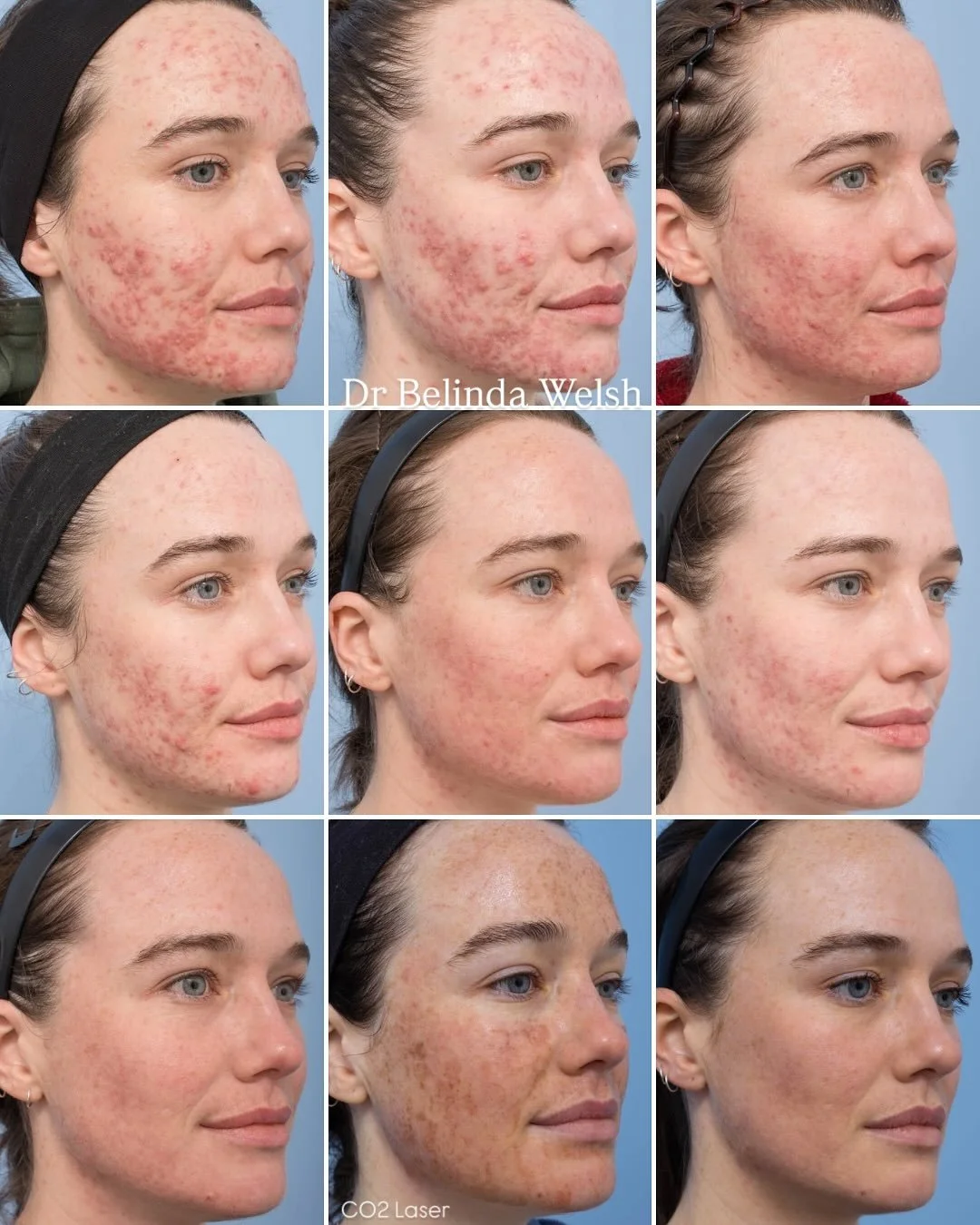 An acne journey ✨

For many patients, acne is more than just &ldquo;breakouts&rdquo;.

It can appear as red, inflamed papules, pustules or even deep cysts. Blocked pores (blackhead and whiteheads). 

Permanent scarring is the most significant outcome