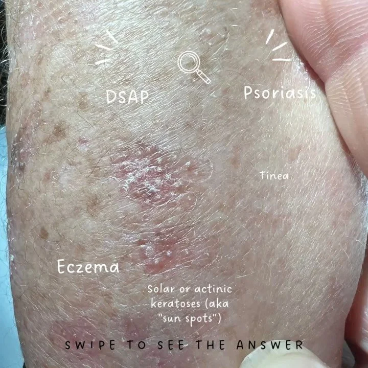 Guess the Condition 🔎

Do you have lesions like these on your forearms and lower legs that are&nbsp;really stubborn ?

📋 Characterisitcs
They are&nbsp;small, annular (ring-shaped), scaly patches
The central&nbsp;area may appear slightly atrophic (t