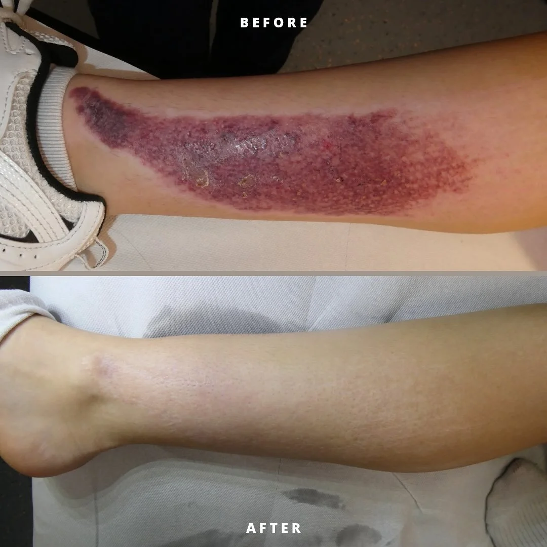 🌿 The Journey to Recovery: Managing Traumatic Scarring After a Car Accident 

Case Summary:
 Our patient, a beautiful young woman, was involved in a motor vehicle accident (MVA) that left her with significant disfiguring scarring on both her lower l