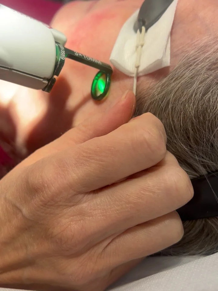 Precision treatment of facial telangiectasia 💥

Telangiectasia or capillaries &mdash; are small, dilated blood vessels visible just beneath the surface of the skin. They commonly appear on the face, particularly around the nose, cheeks, and chin.
⠀
