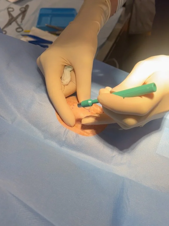 ⚠️ Clinical Content / Minor Procedure Disclaimer⚠️

This post contains educational discussion of a minor surgical extraction. Viewer discretion is advised.

⸻

🔹 Minimally invasive Lipoma removal 

A Lipoma is a benign, slow-growing fatty tumour tha