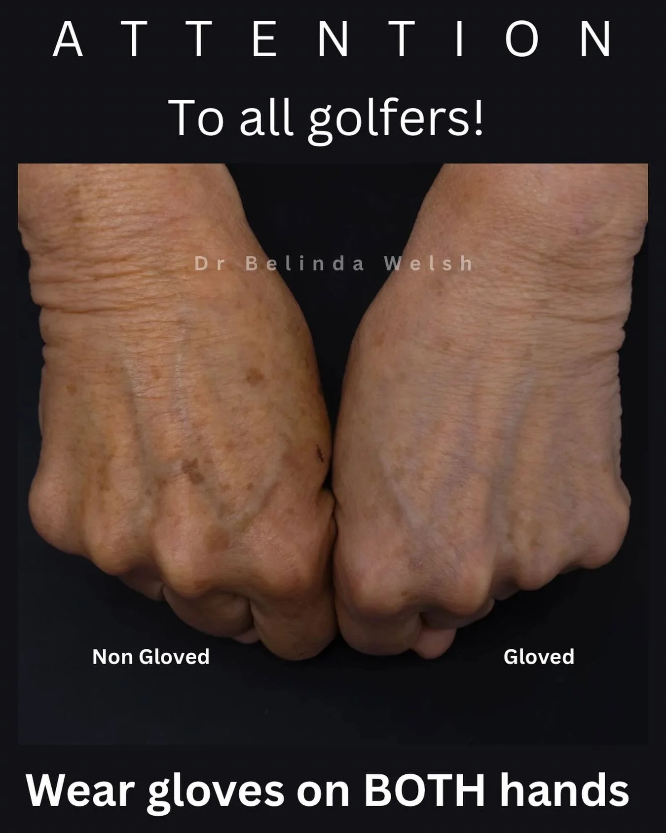 This lovely lady started playing golf two years ago, and has consistently worn a glove ONLY on her left hand. Her unprotected right hand had direct sun exposure throughout each game.

This has caused a striking difference in the skin on the back of h
