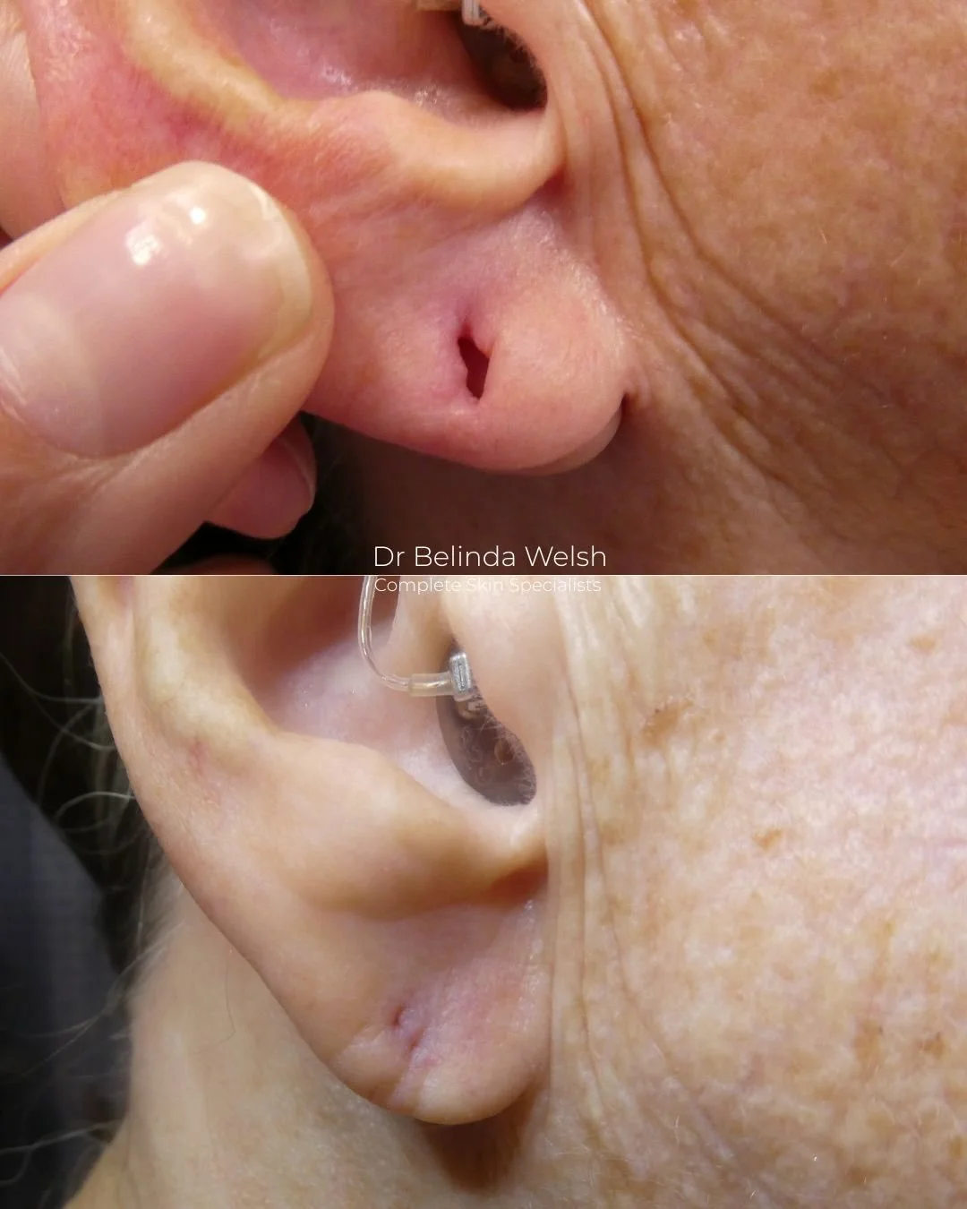⚠️ Warning: Surgical Content Below

This treatment is called a wedge resection of the earlobe. It is a minor surgical procedure used to repair elongated, torn, or stretched earlobes&mdash;mostly caused by long-term traction from heavy earrings.

Duri