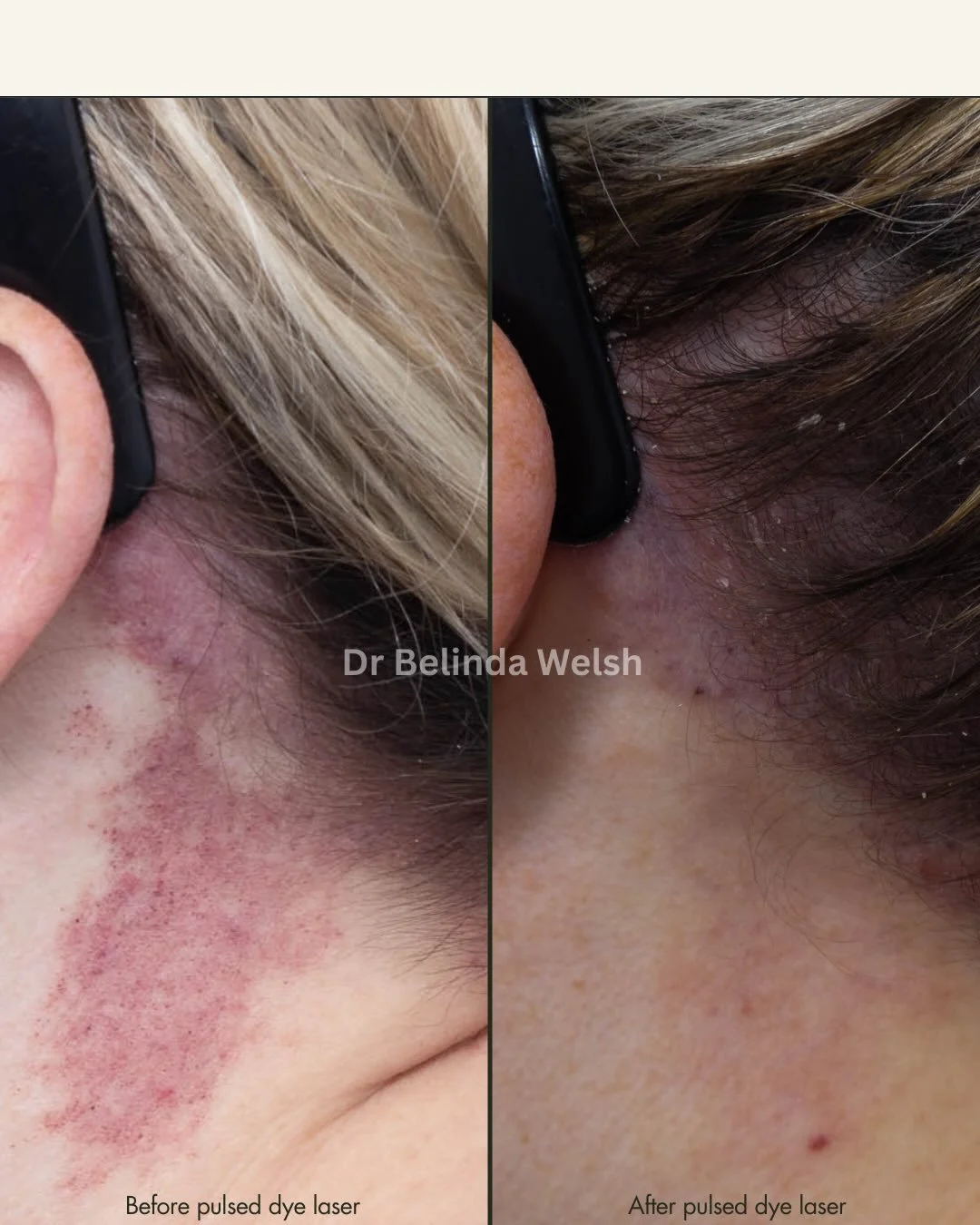 Port wine stain birthmark treatment with pulsed dye laser (V beam)💥

Images 
1. The before and after of a&nbsp;&nbsp;Port Wine Stain on the neck after 2 treatments 

2. The immediate skin response post test patch with bruising being the desired end 