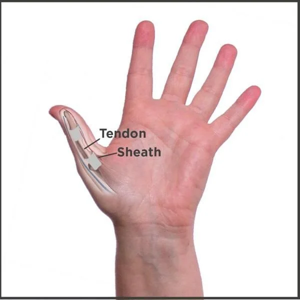 Can Essential Oils Help With Trigger Thumb?