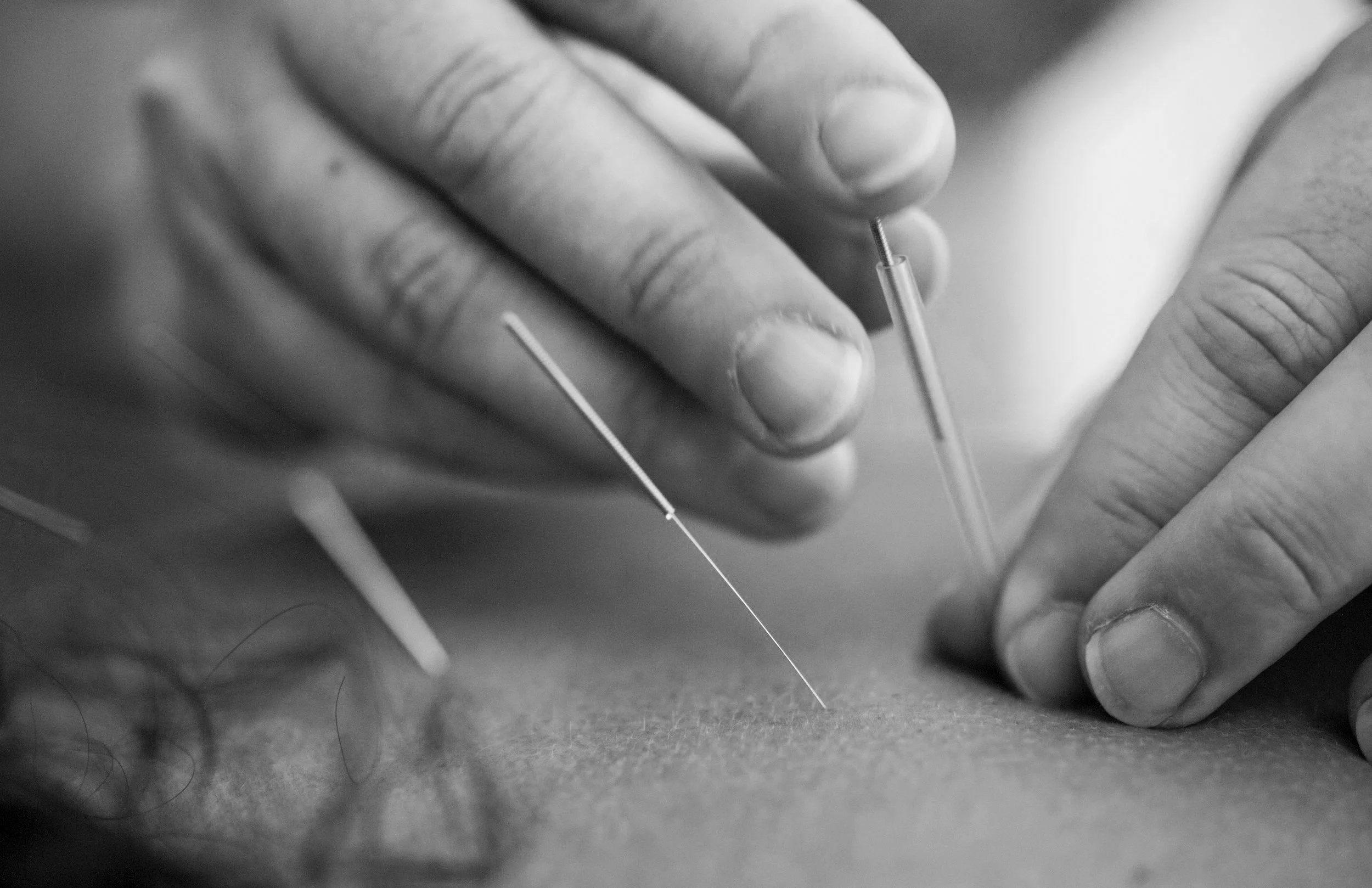 Dry Needling