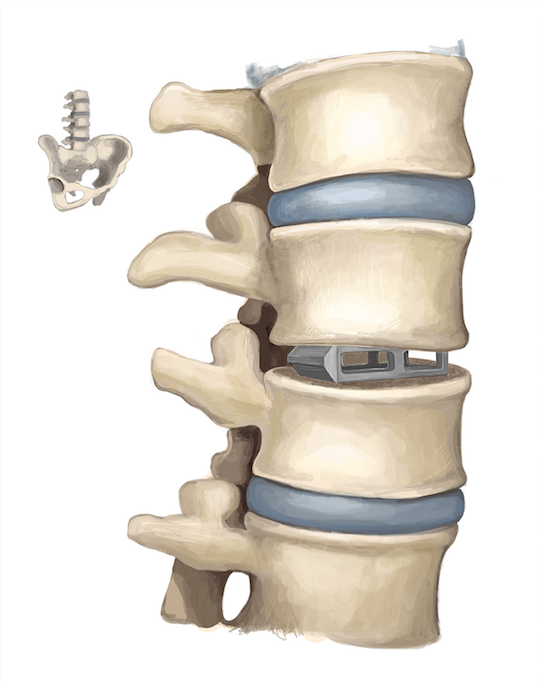 spinal+implant+for+BC+site.png