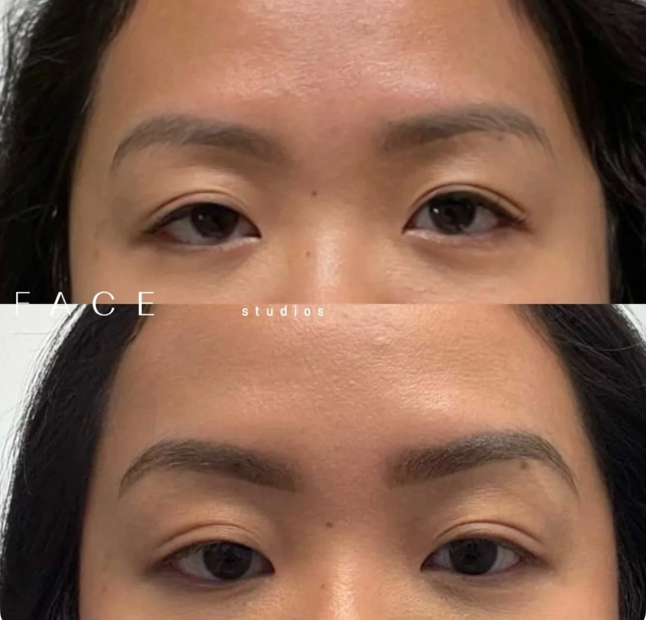 Brow lift w/ tox ✨

Lateral brow lift + arch to create a subtle, more open appearance of the eyes. This treatment can enhance lid space and help improve natural brow asymmetries

WWW.FACESTUDIOS.CA