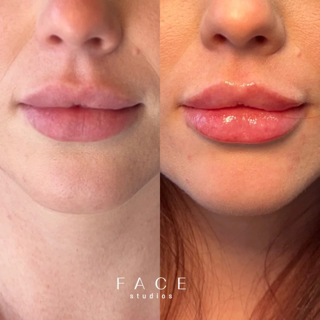 Strategic product placement &amp; respecting individual lip anatomy, creates results that look natural, balanced, and tailored. This angel had beautiful lips to start, healthy tissue to work with to achieve this particular shape and naturally had spa