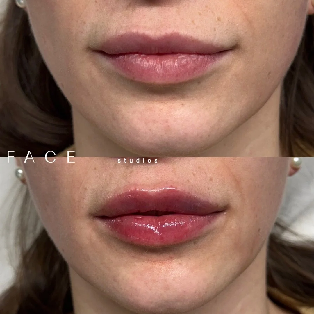 Asymmetry correction + upper/lower ratio balancing💉

(Don&rsquo;t worry, she&rsquo;s fine! Bruising is very common)

How to prevent bruising during treatment?
&bull; Avoid alcohol, Advil/Aspirin/Moltrin or blood thinning medications for 24-48 hrs be