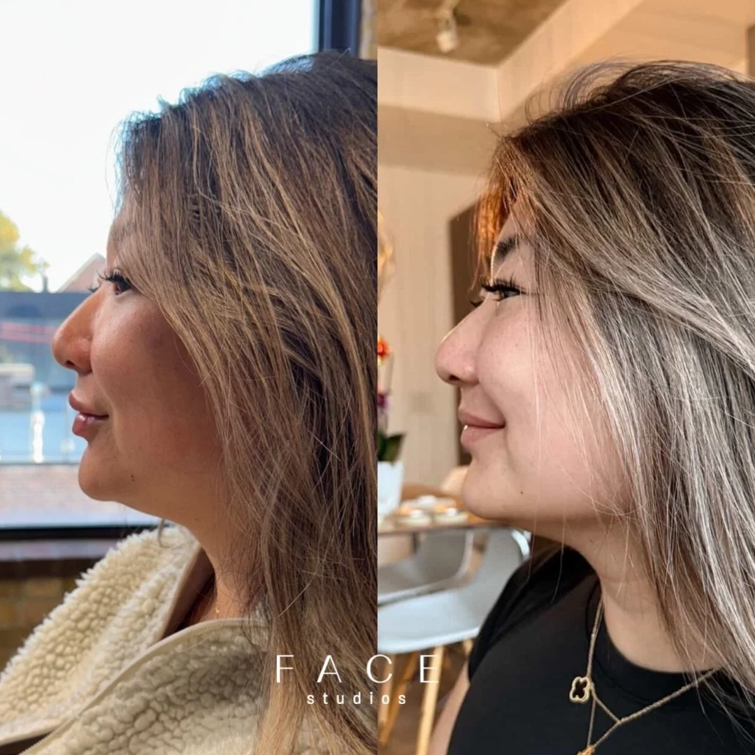 The power of the Nefertiti Lift ✨

What is it?
Strategically placed neurotoxin (Botox, Dysport, Xeomin, Nuceiva) along the DAO muscle, jawline + neck aka platysmal muscles

How does it work?
The muscles treated in this area are in the lower half of t