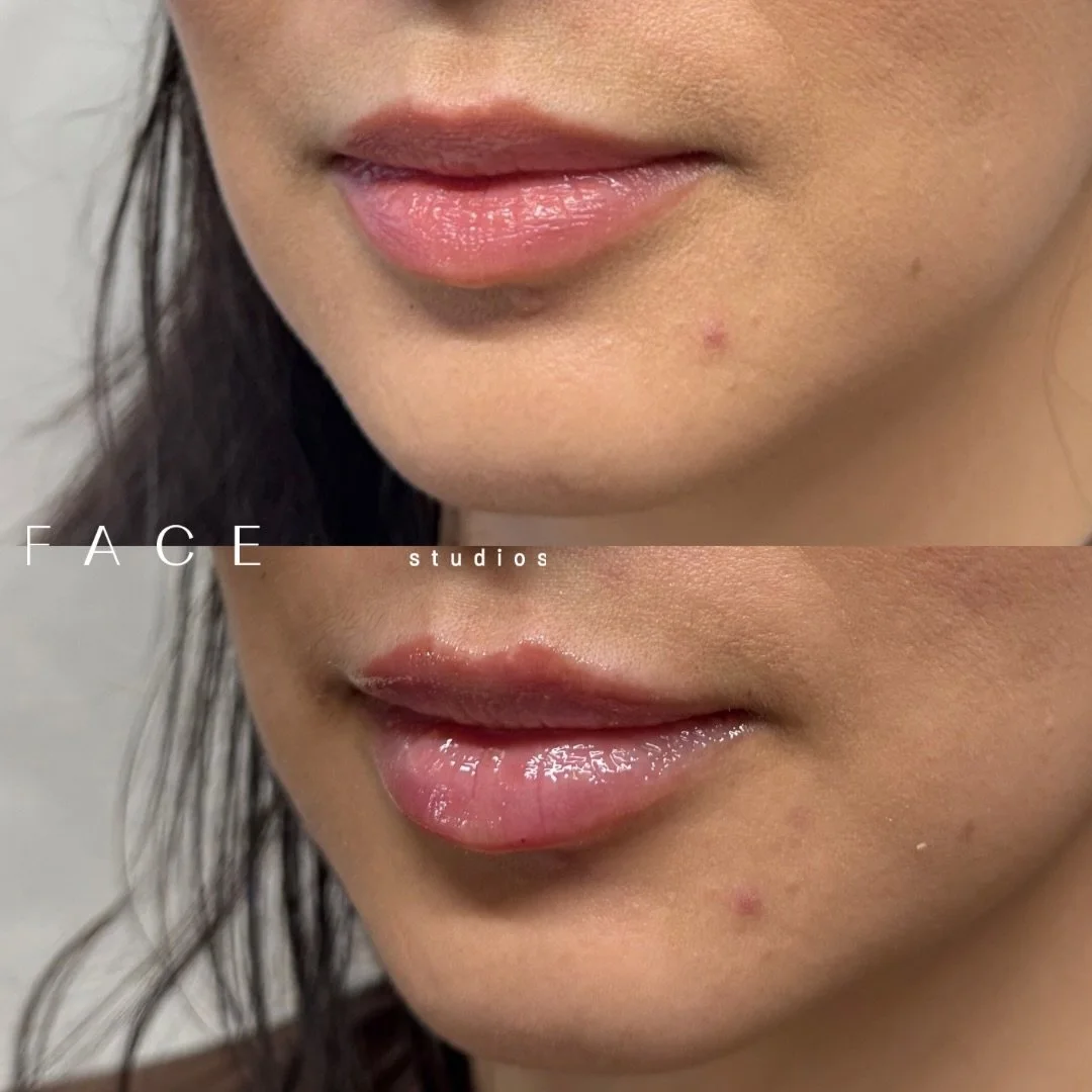 Natural lip filler results using @revanesse ✨

We are loving the shift towards natural-looking results and a more balanced approach to enhancing the lips and facial contours. The goal is always harmony, softness, and results that are never over done!