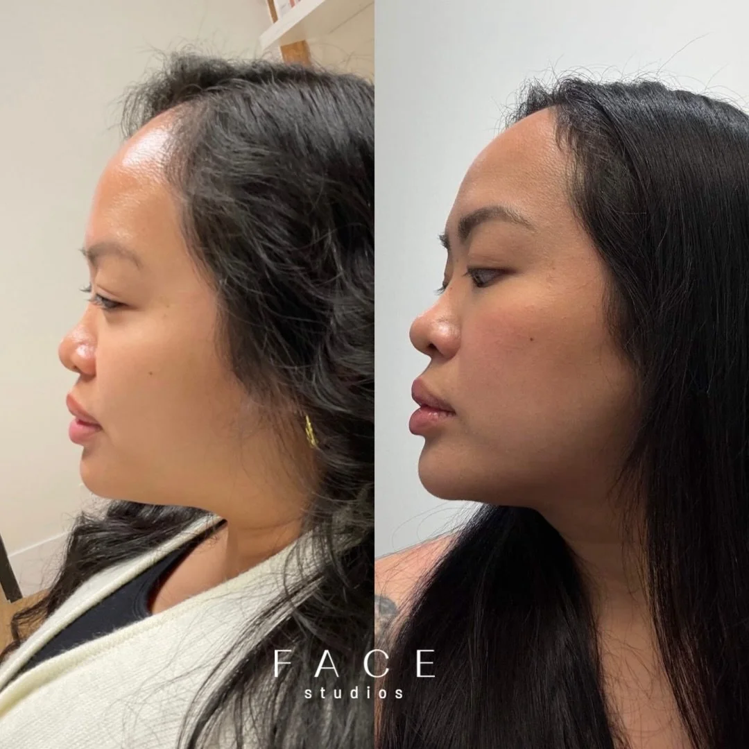 The Nefertiti Lift ~

An advanced neurotoxin (Dysport/Botox etc.) technique that targets the platysma muscle in the neck and jawline. By relaxing the downward pull of this muscle, the jawline appears more defined, the neck looks smoother, and the low