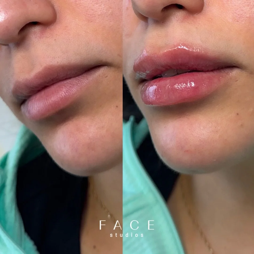 Wedding prep for a long time client 💍

We aimed for a full syringe and achieved these beautiful results with 0.7ml of @stylage dermal filler. Less was definitely more in this case and we are loving the refreshed pout!

WWW.FACESTUDIOS.CA 🤍