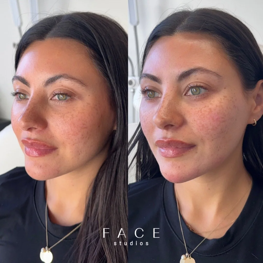 Pre wedding facial balancing for Nurse Mel at @juicemedspa 💍💉

We treated this gorg face with dermal filler in her cheeks to lift and support this area, chin to balance her profile and slightly elongate the face + chin shadows 

Absolutely love see