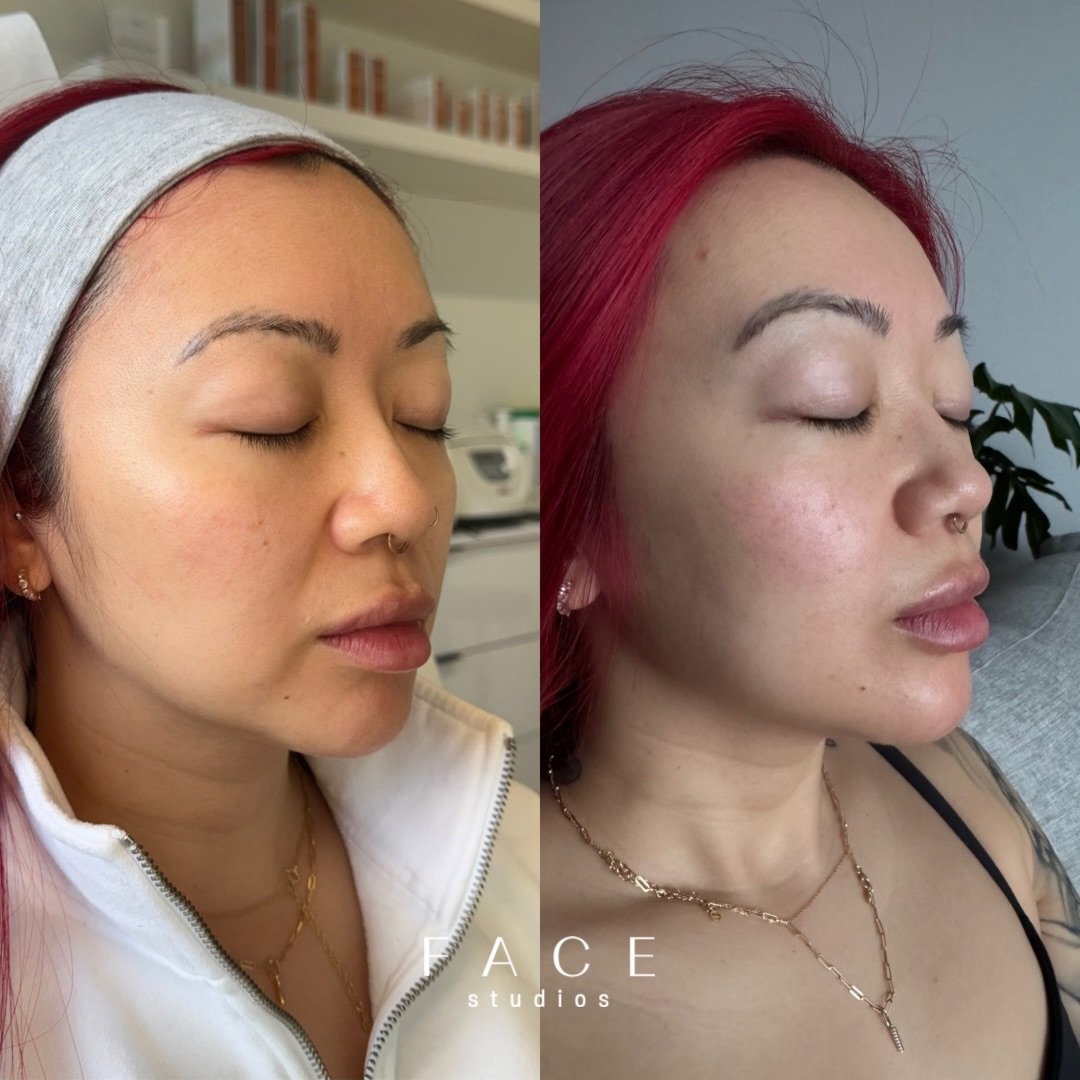 Obsesssssed😍

Lower face dermal filler x Nefertiti lift with tox have been highly requested and I&rsquo;m here for it. As someone who struggles with lower face definition myself, these treatments have been a game changer! Can we take in this beauty 