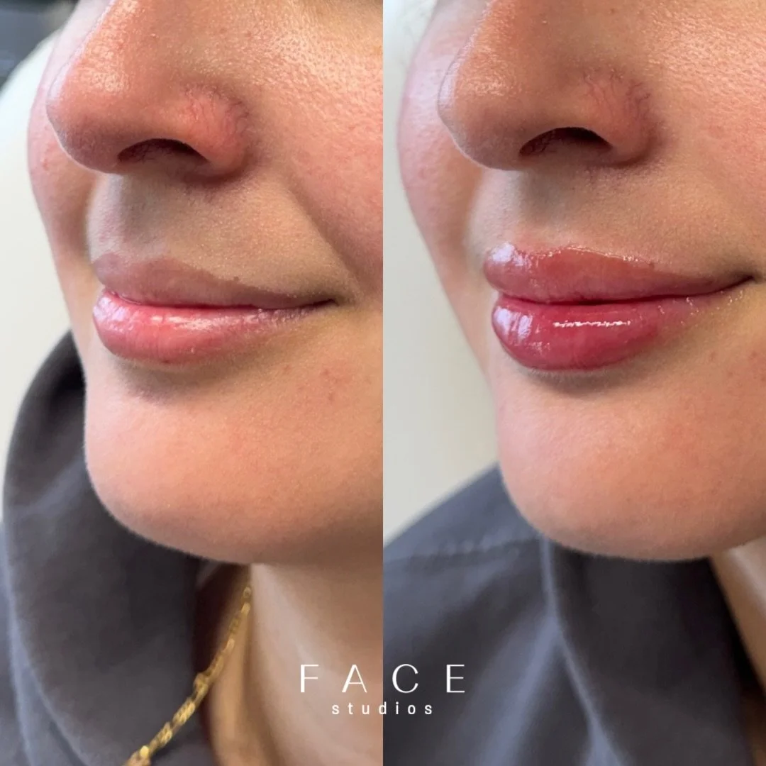 Pre Miami lippies for my girl @marlenanaguit 🩷

1/2 syringe of @vivacy_ca Stylage M for these natural results! Thanks for all the trust and all the yapping 

WWW.FACESTUDIOS.CA