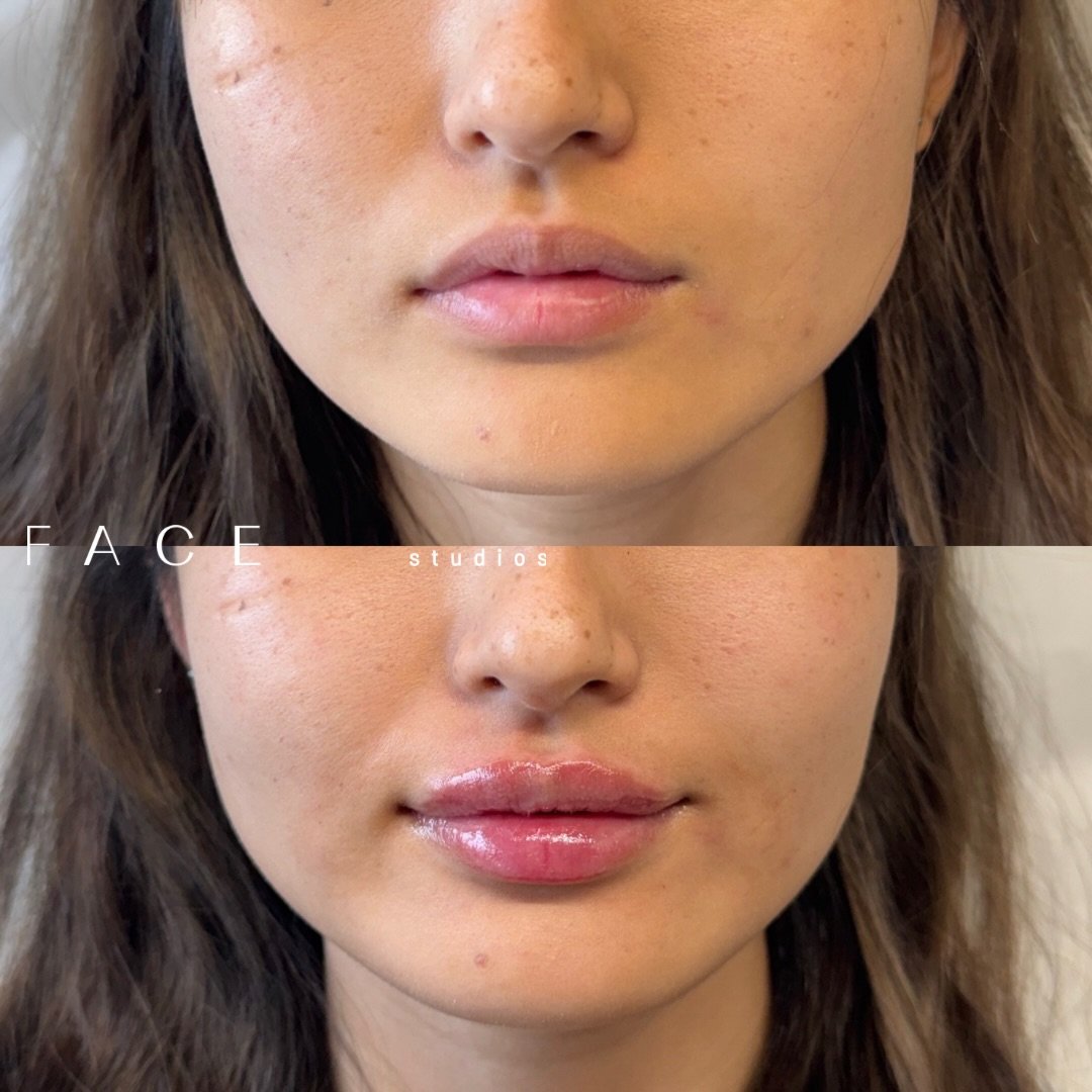 Not all lips can be treated the same! M-shaped lips require a more advanced approach with intentional placement, precise product choice, and respect for their natural anatomy. In many cases, results are built gradually over multiple treatments to mai