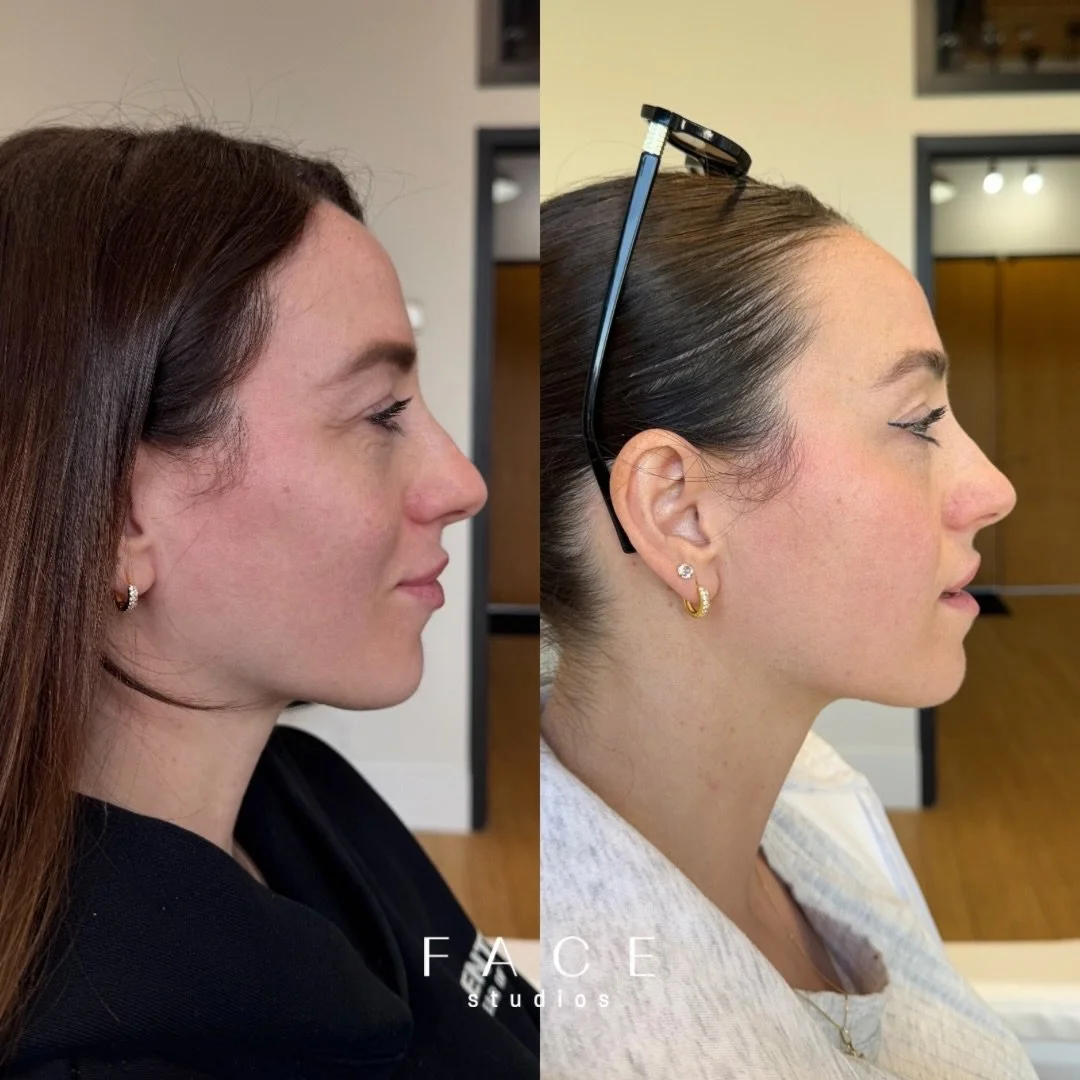 Chasing your friends for after photos 😮&zwj;💨

Neck is elongated, submental area reduced, jawline defined &amp; overall profile enhanced, helloooooooo? @tanya_warner @hairby.tanyawarner 

Book a consult or treatment w/ me 🤍

WWW.FACESTUDIOS.CA