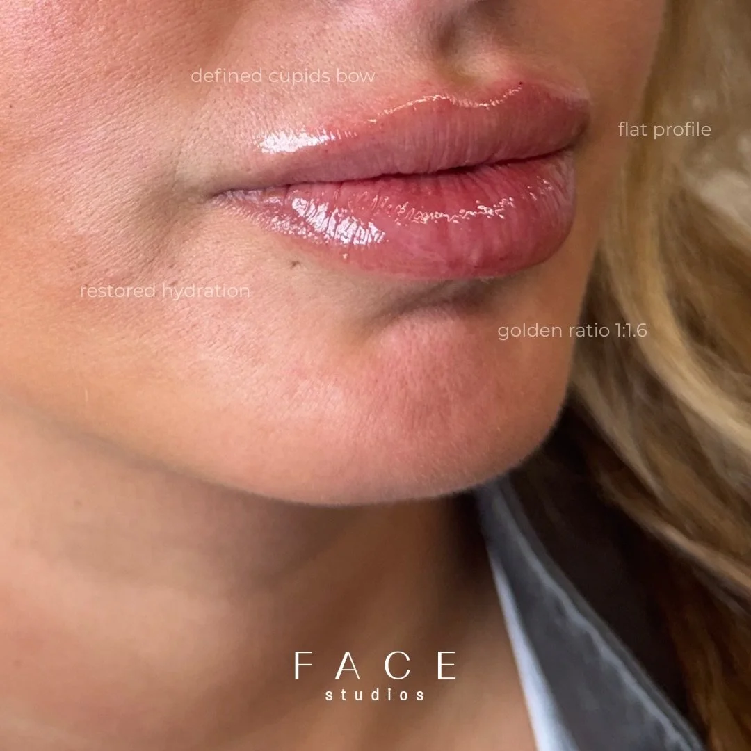 Fresh off the needle 💉

WWW.FACESTUDIOS.CA to book or learn more