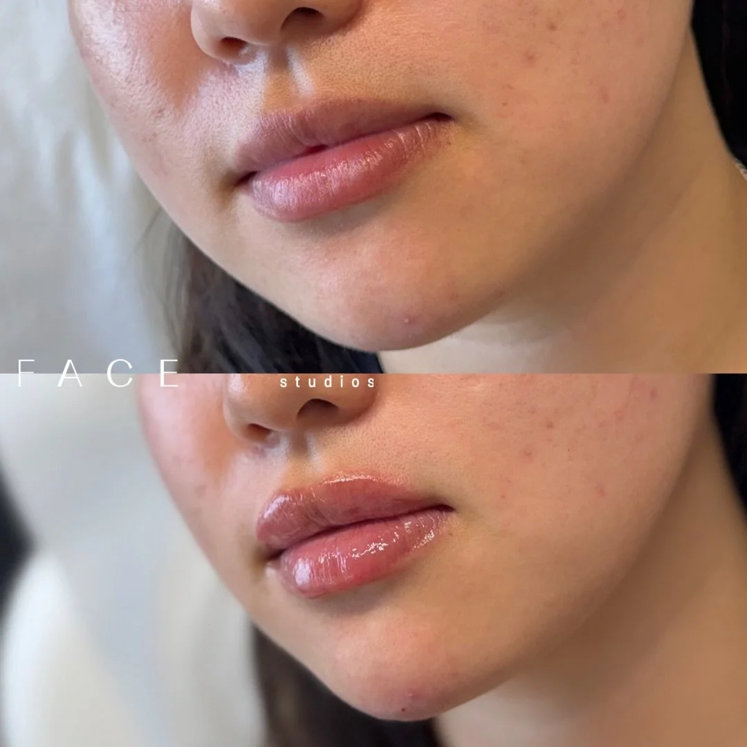 &ldquo;I want even ratios &amp; rounded shaped lips&rdquo; &hellip; say less 💉

Depending on your lip anatomy, tissue quality, and your lips&rsquo; capacity for dermal filler, your results can be fully customized to suit your features and aesthetic 