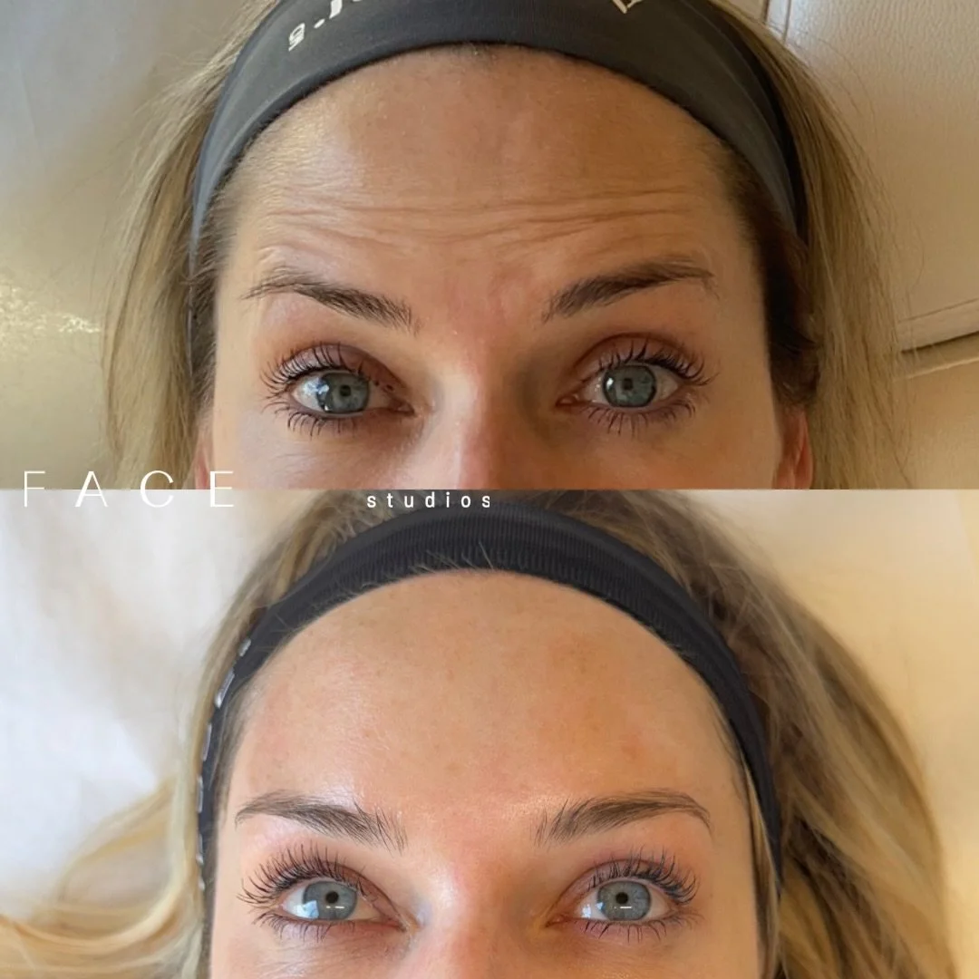 Helloooooo? What forehead wrinkles or 11&rsquo;s?

We&rsquo;ve been pairing tox and microneedling over the course of several months to not only maintain my gorg client&rsquo;s skin and glow but to also prep her for her big day 💍 

Results aren&rsquo