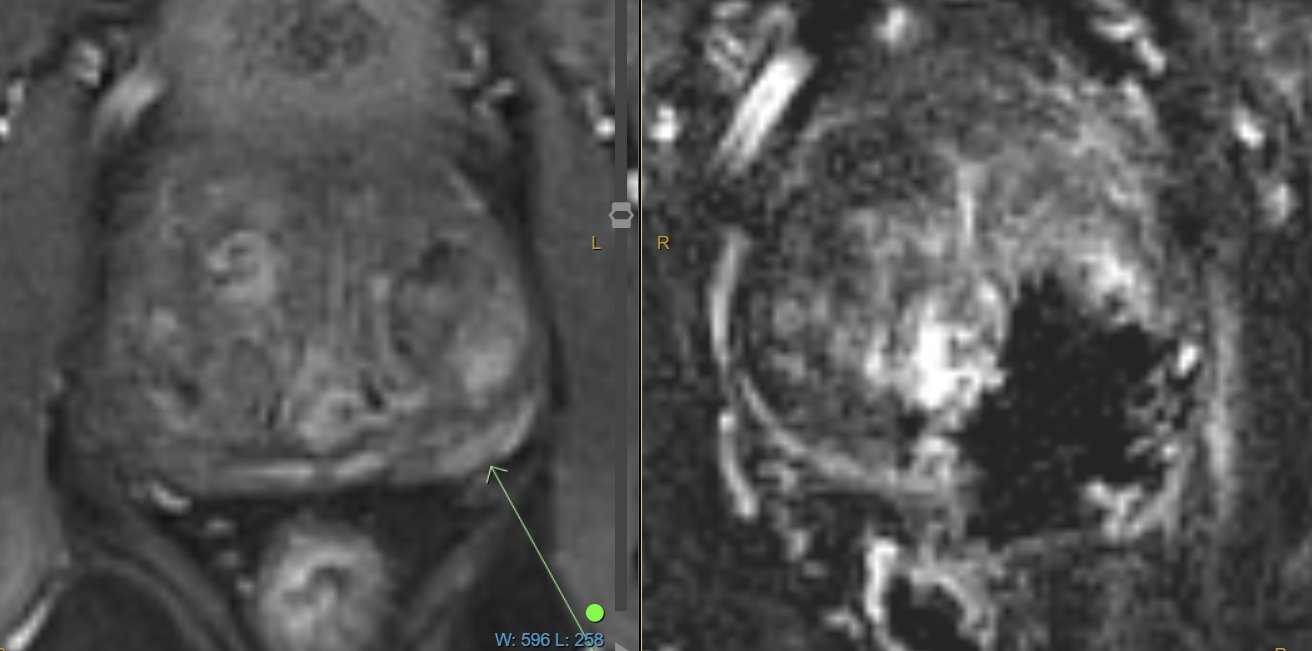 Case Study: Treating Prostate Cancer with NanoKnife Focal Therapy
