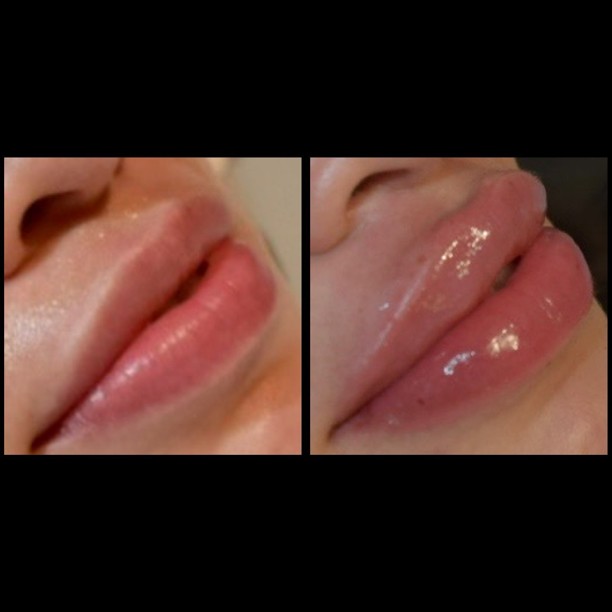 Using Revanesse Lips to hydrate and plump her lips.  Filler lasts 9-12 months. 👄💉😘

Text 551-355-1450 or Book online at www.linealounge.com

#lipfillerbeforeandafter#lipfiller#lipplump#lipaugmentation#revanesselips#lipinjections#dermalfillerslips#
