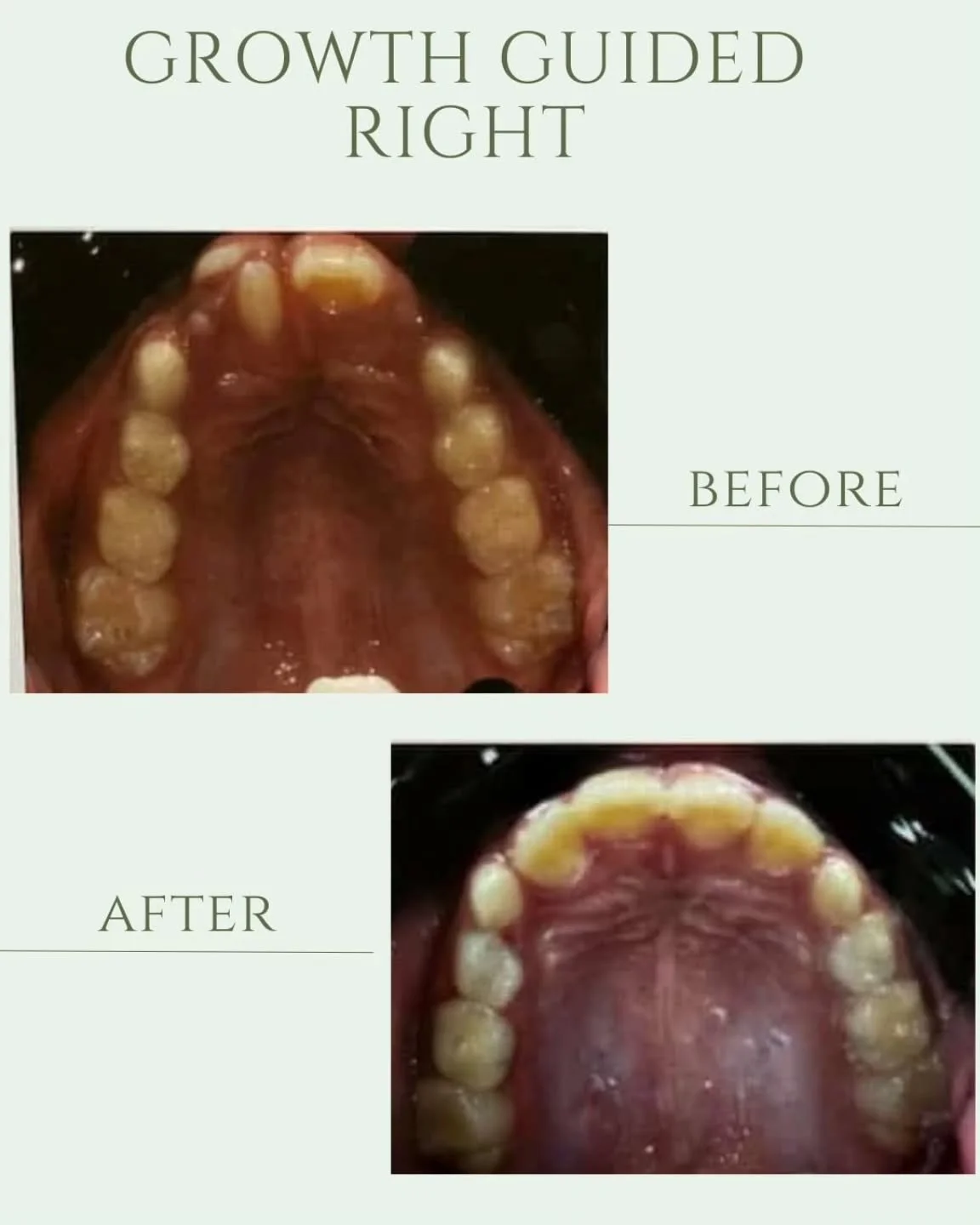 ✨ Teamwork = Smiles! ✨

At our practice, you don&rsquo;t just get great care &mdash; you get collaborative care. 💙

This awesome kid started with us at age 7. Our board-certified pediatric dentist gently removed his extra tooth, then our orthodontis