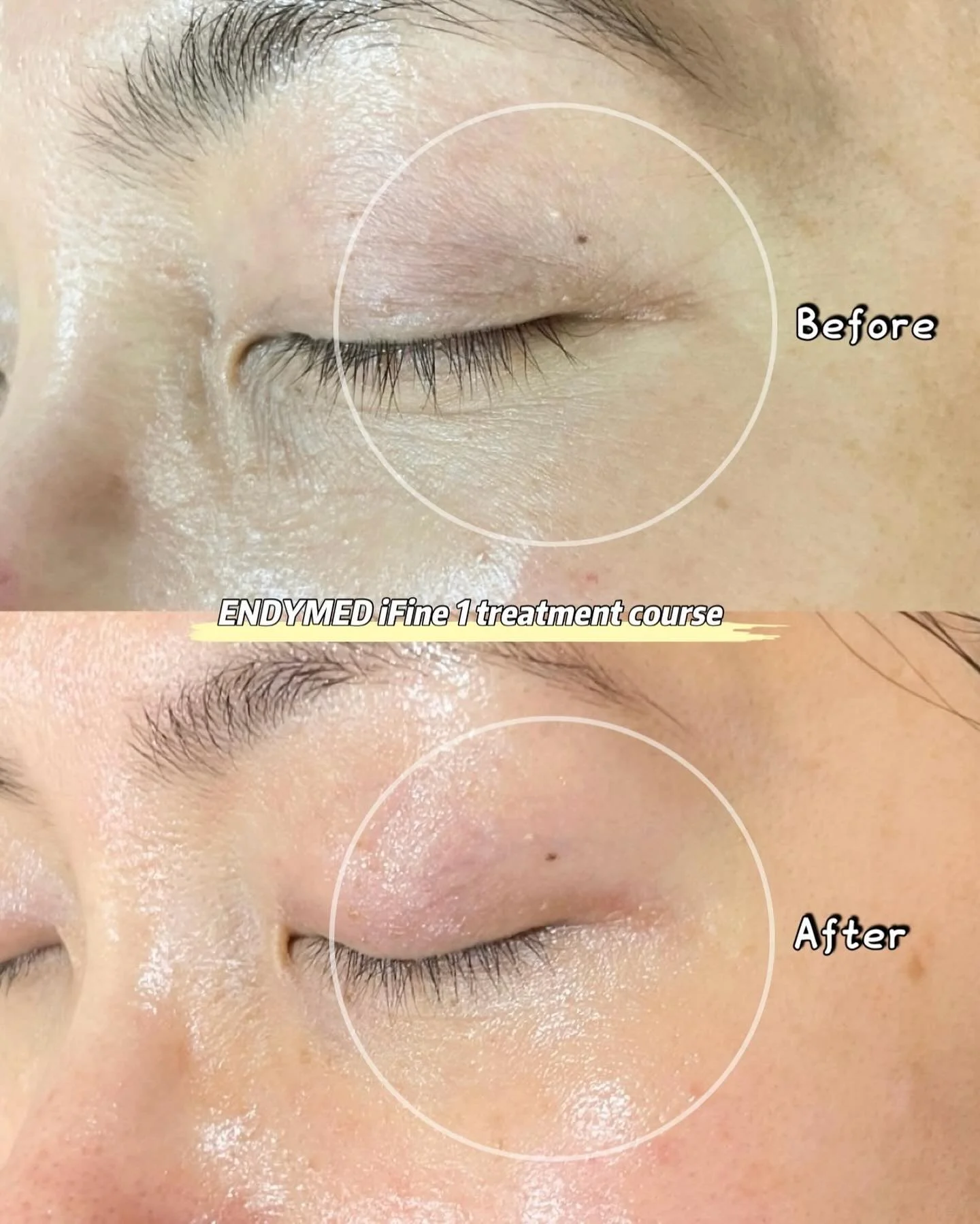 Close-up of someone's closed eyelid showing before and after images of a skin treatment, labeled "ENDYMED iFine 1 treatment course."