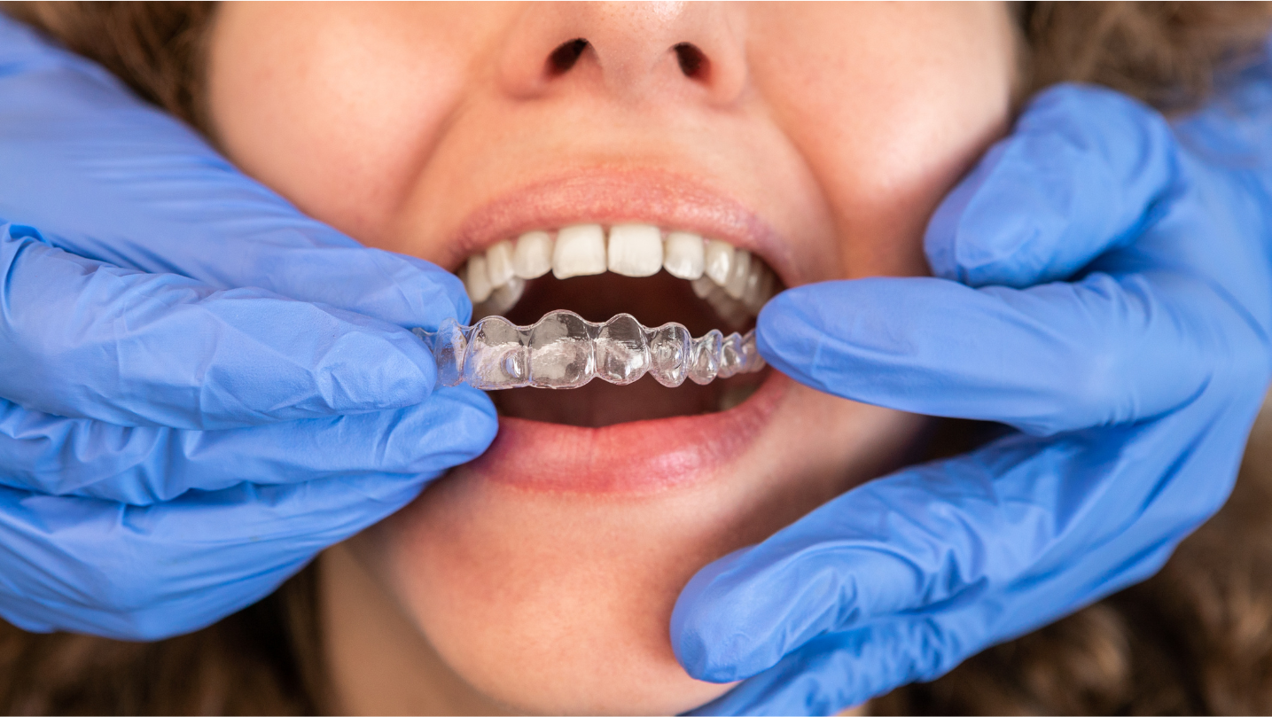 Schluss mit schiefen Zähnen: Warum Invisalign in Baden gerade jetzt boomt